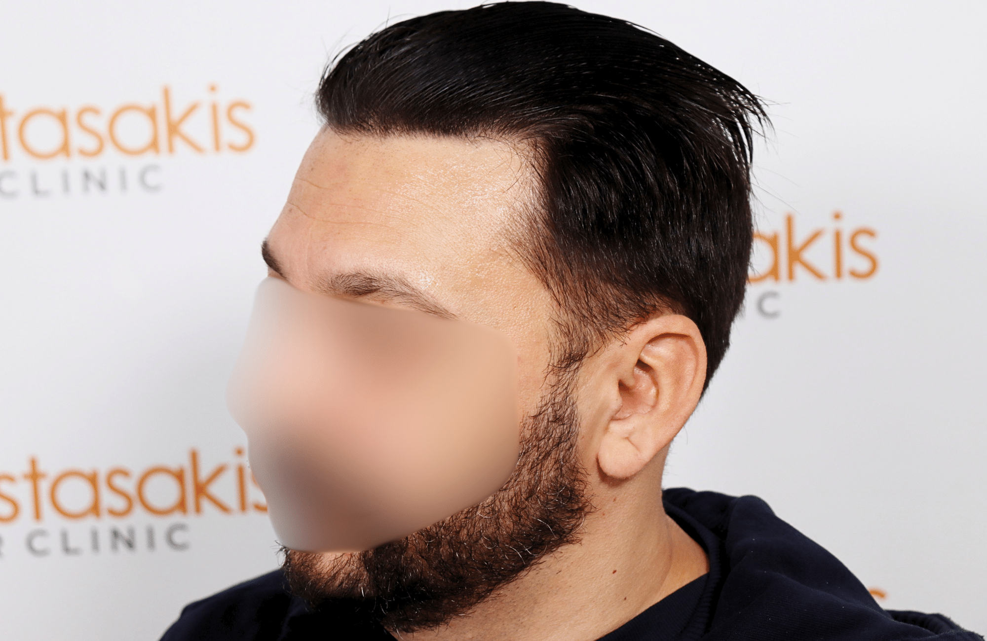 hair transplant result 2000 fus stage 4 crown thick
