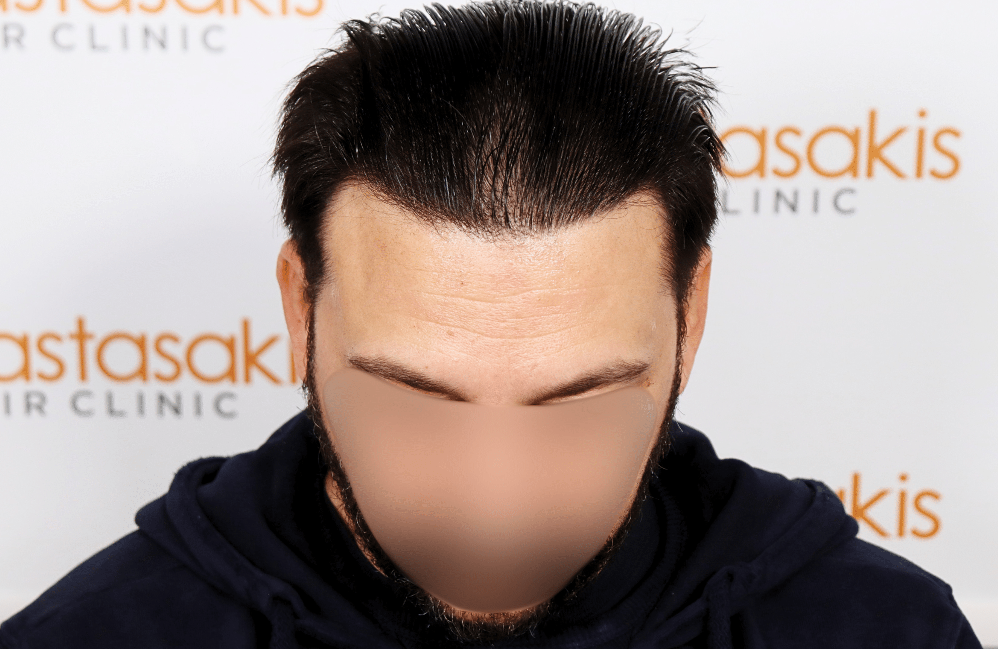 hair transplant result 2000 fus stage 4 crown thick