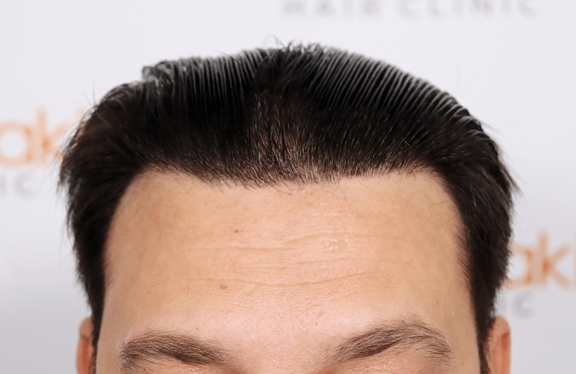 hair transplant result 2000 fus stage 4 crown thick