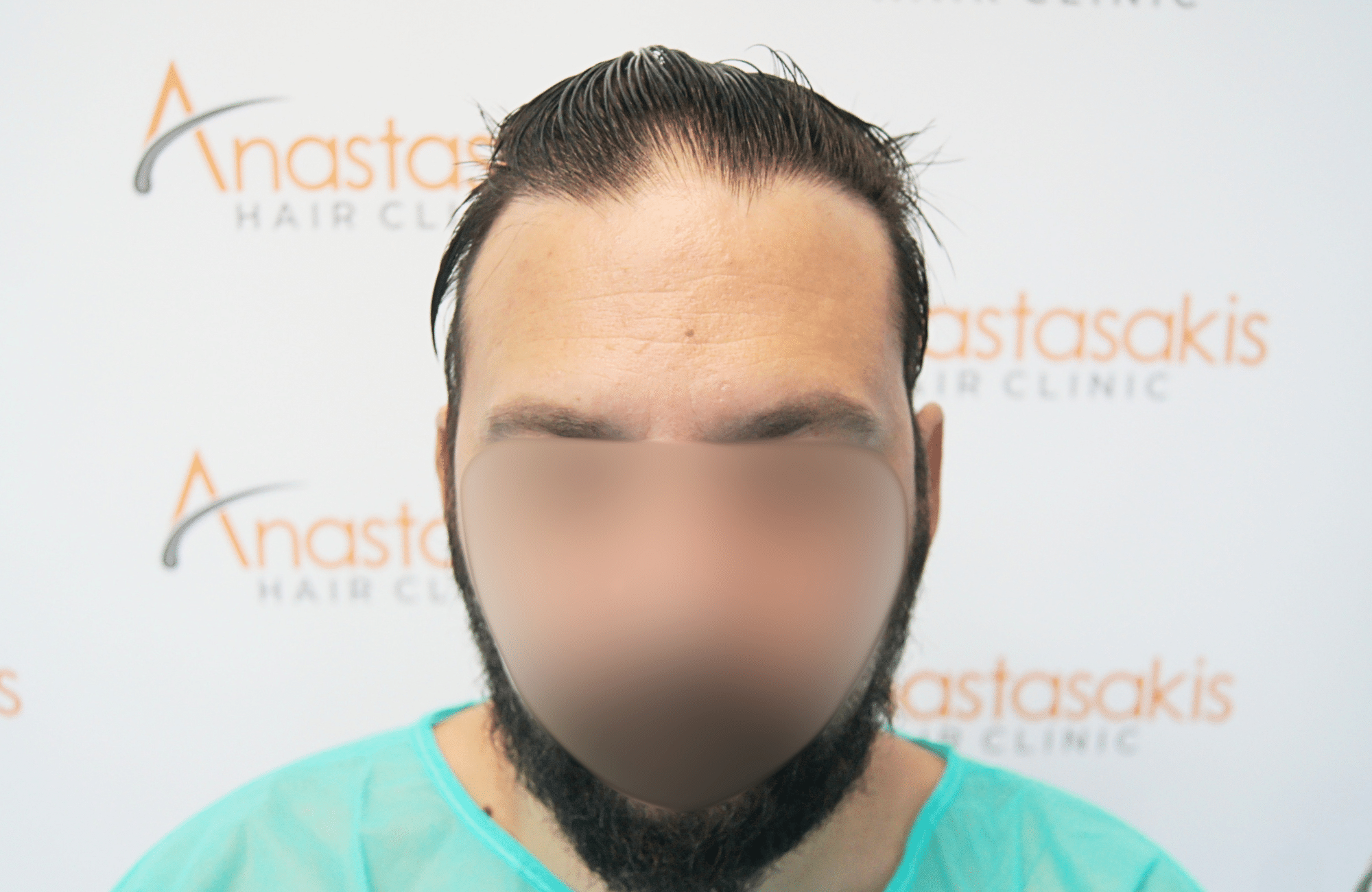 hair transplant result 2000 fus stage 4 crown thick