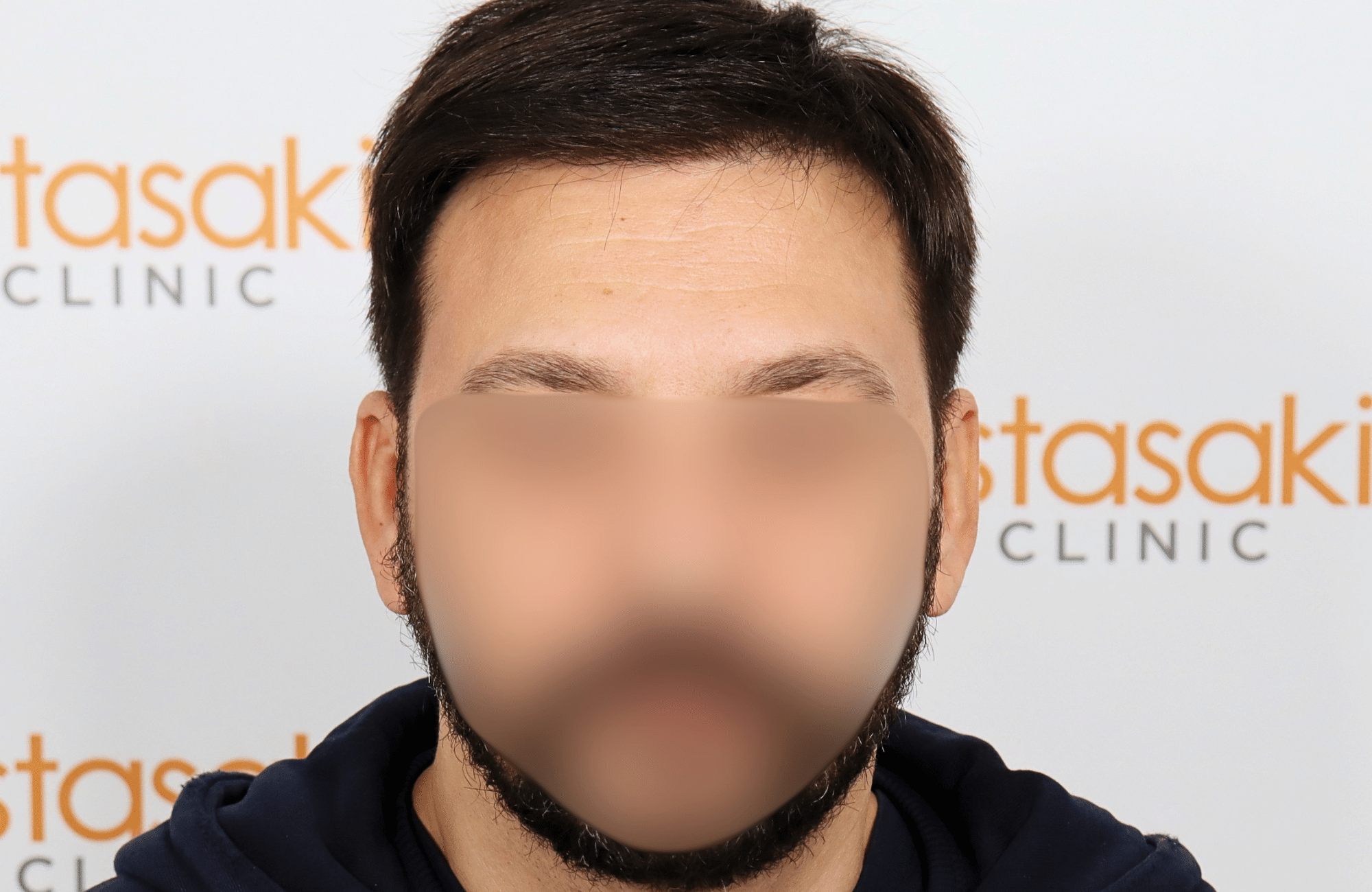 hair transplant result 2000 fus stage 4 crown thick
