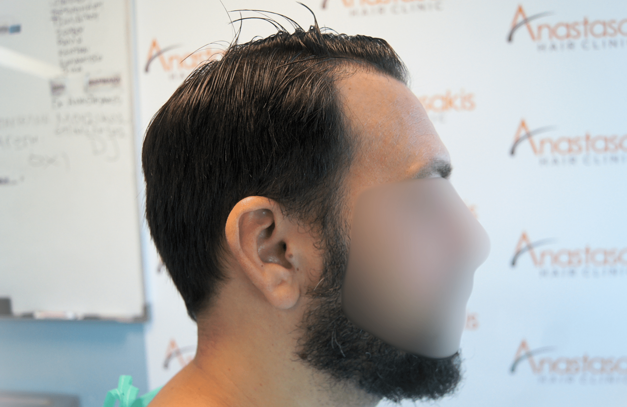 hair transplant result 2000 fus stage 4 crown thick