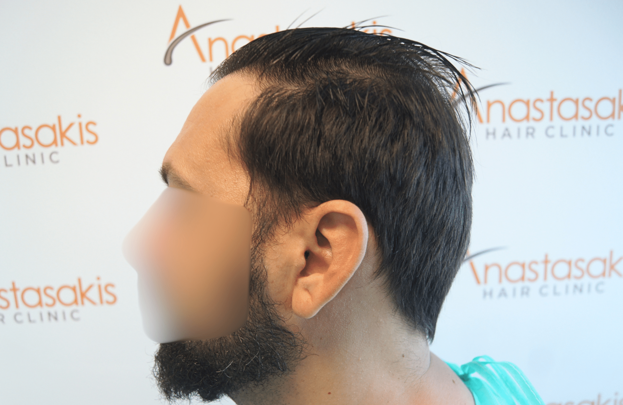 hair transplant result 2000 fus stage 4 crown thick