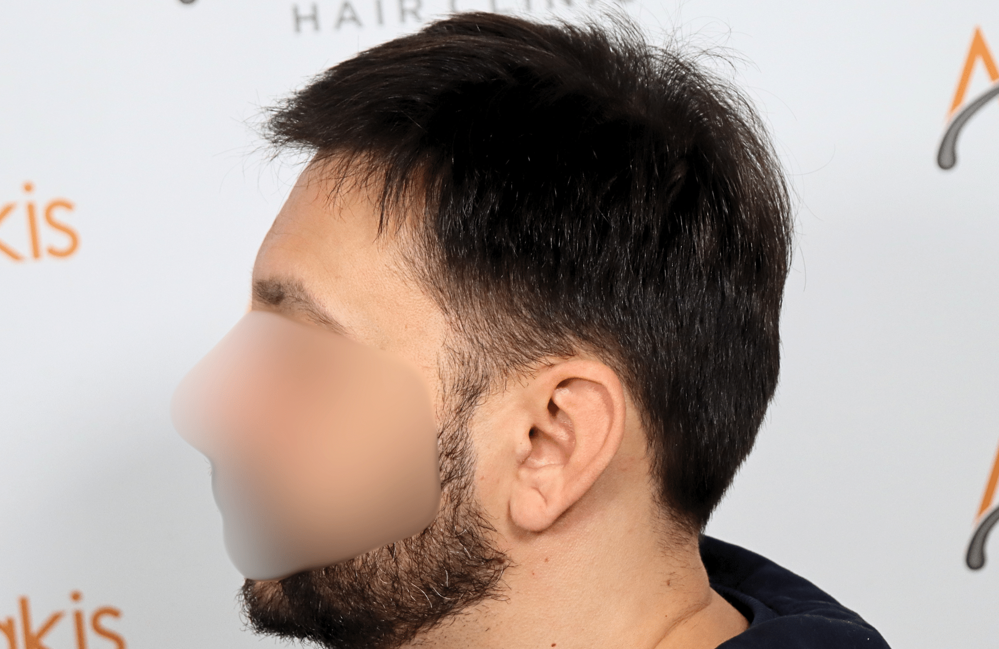 hair transplant result 2000 fus stage 4 crown thick