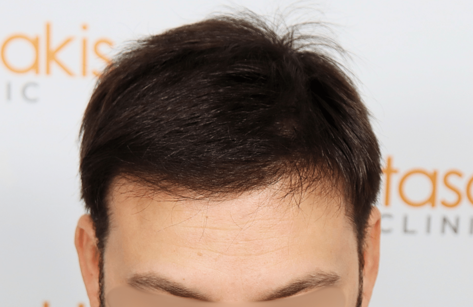 hair transplant result 2000 fus stage 4 crown thick