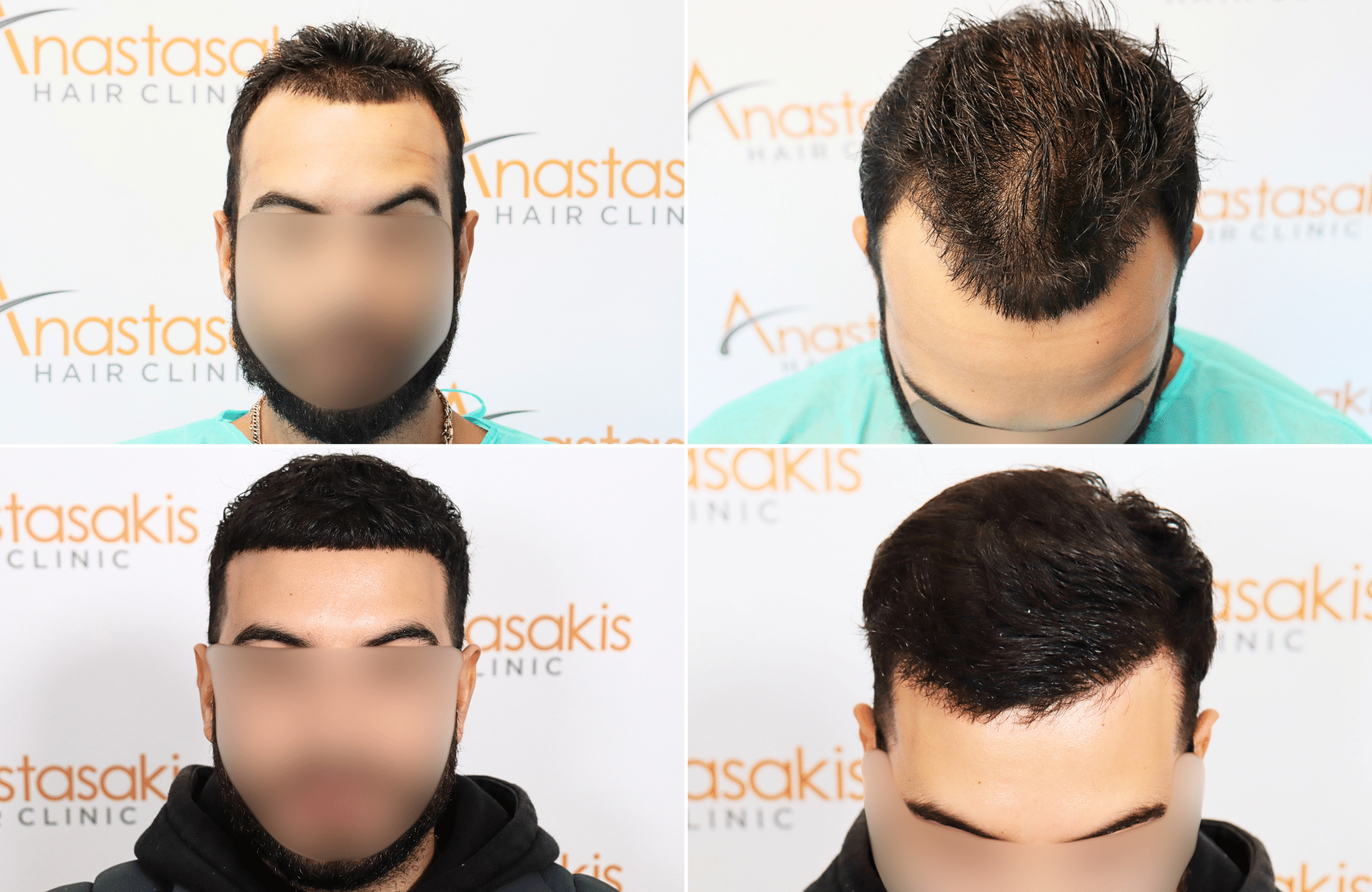 https://www.anastasakishairclinic.gr/portfolio/apotelesma-metamosxefsis-mallion-anastasakis-hair-clinic-198/