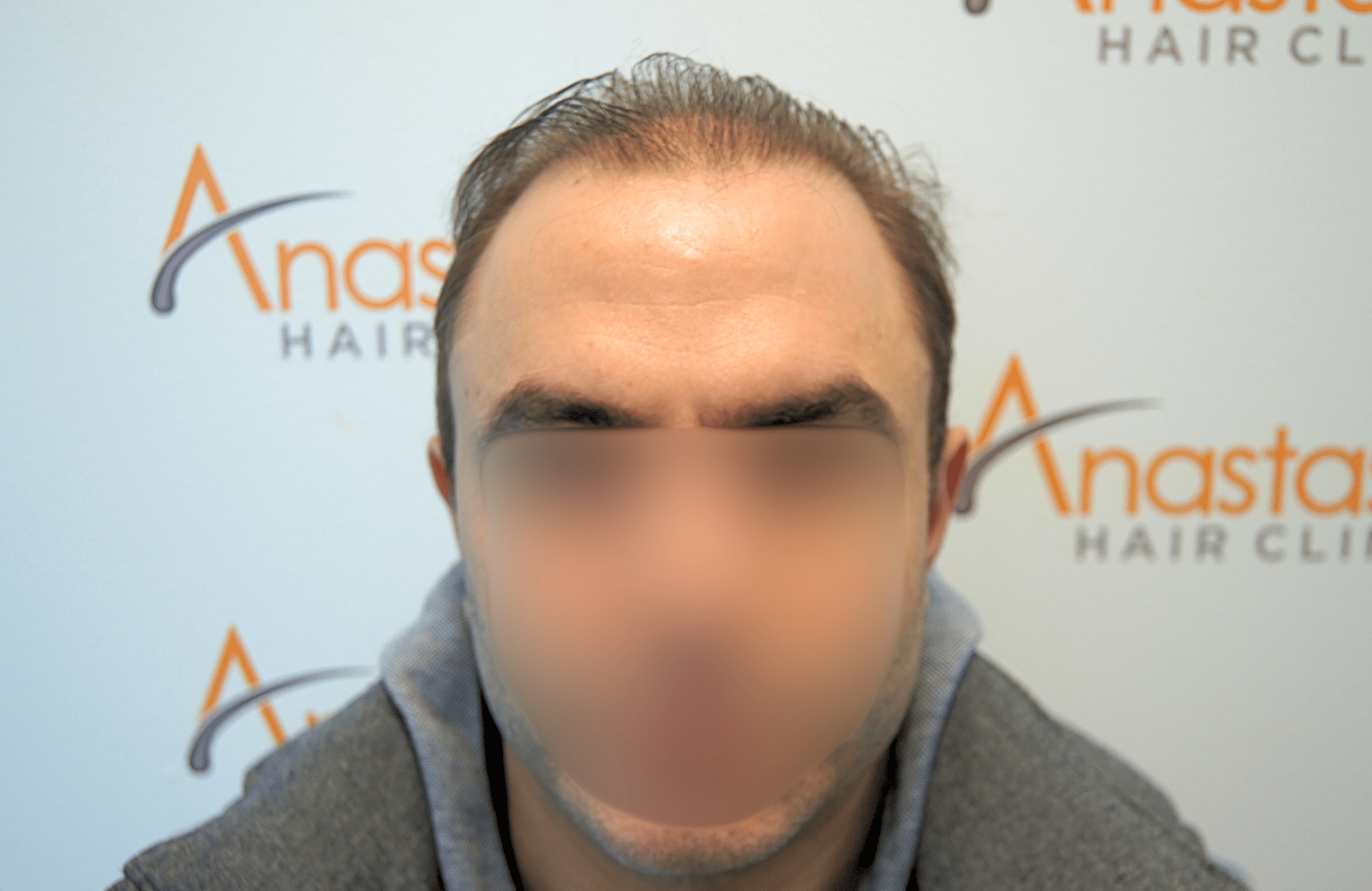 hair transplant result 5200 fus light (1)