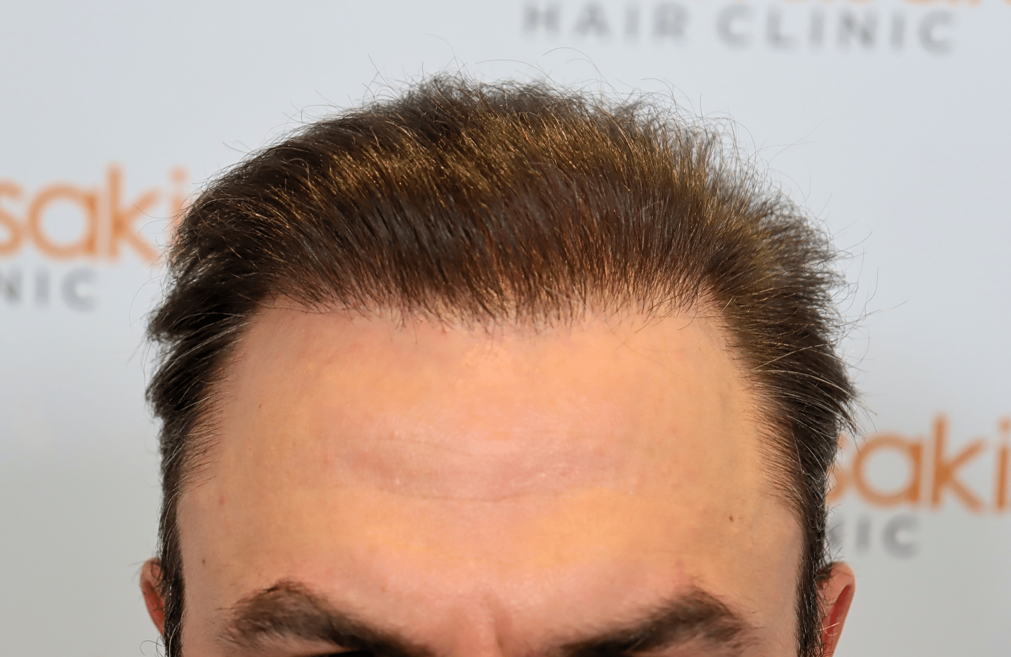 hair transplant result 5200 fus light (10)