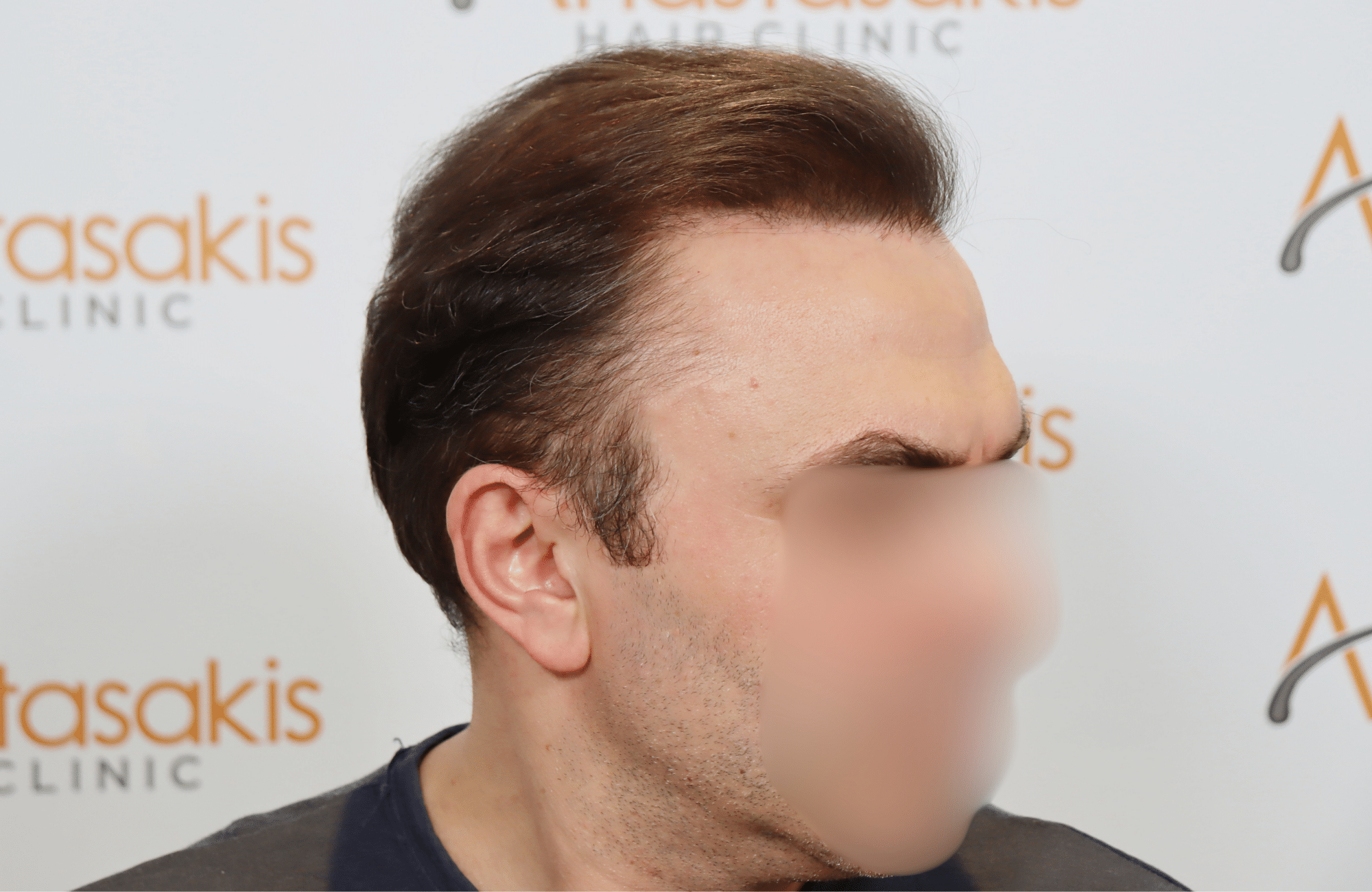 hair transplant result 5200 fus light (11)