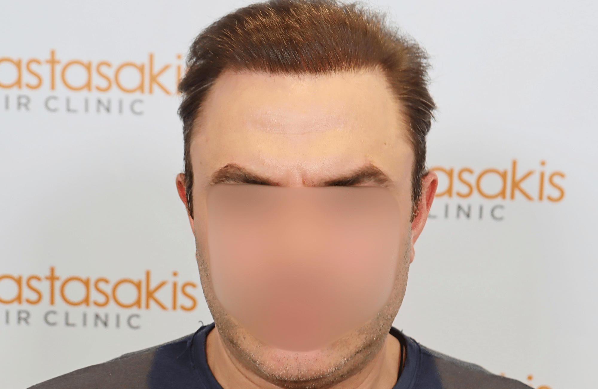 hair transplant result 5200 fus light (2)