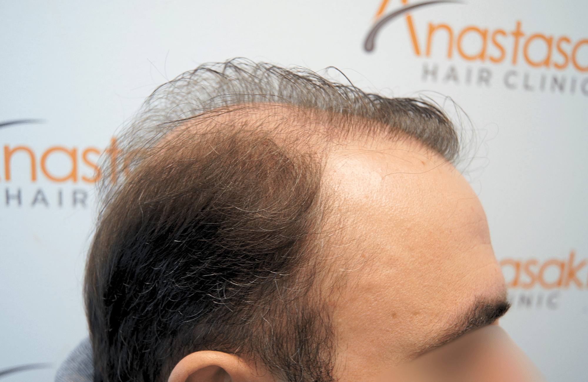 hair transplant result 5200 fus light (3)