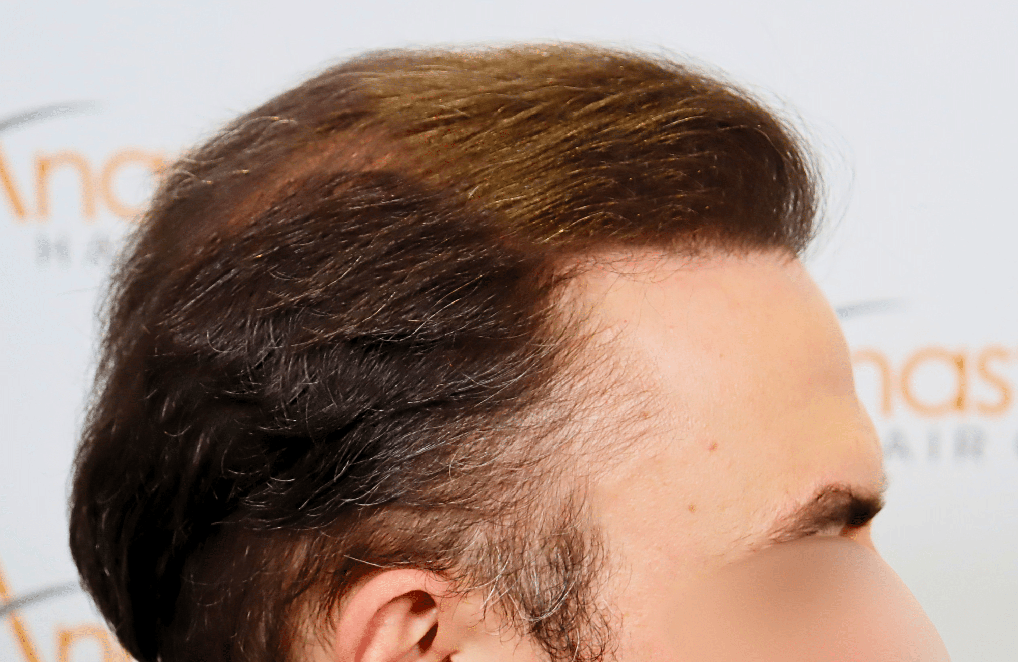 hair transplant result 5200 fus light (4)