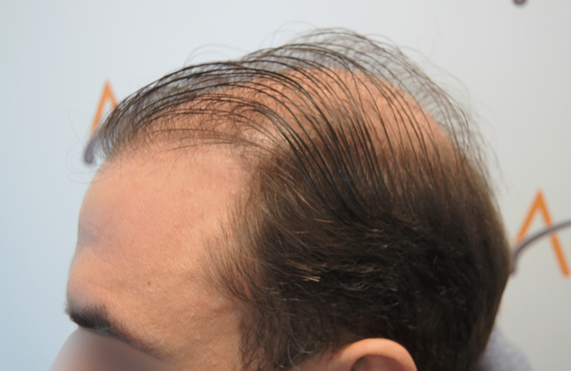 hair transplant result 5200 fus light (5)