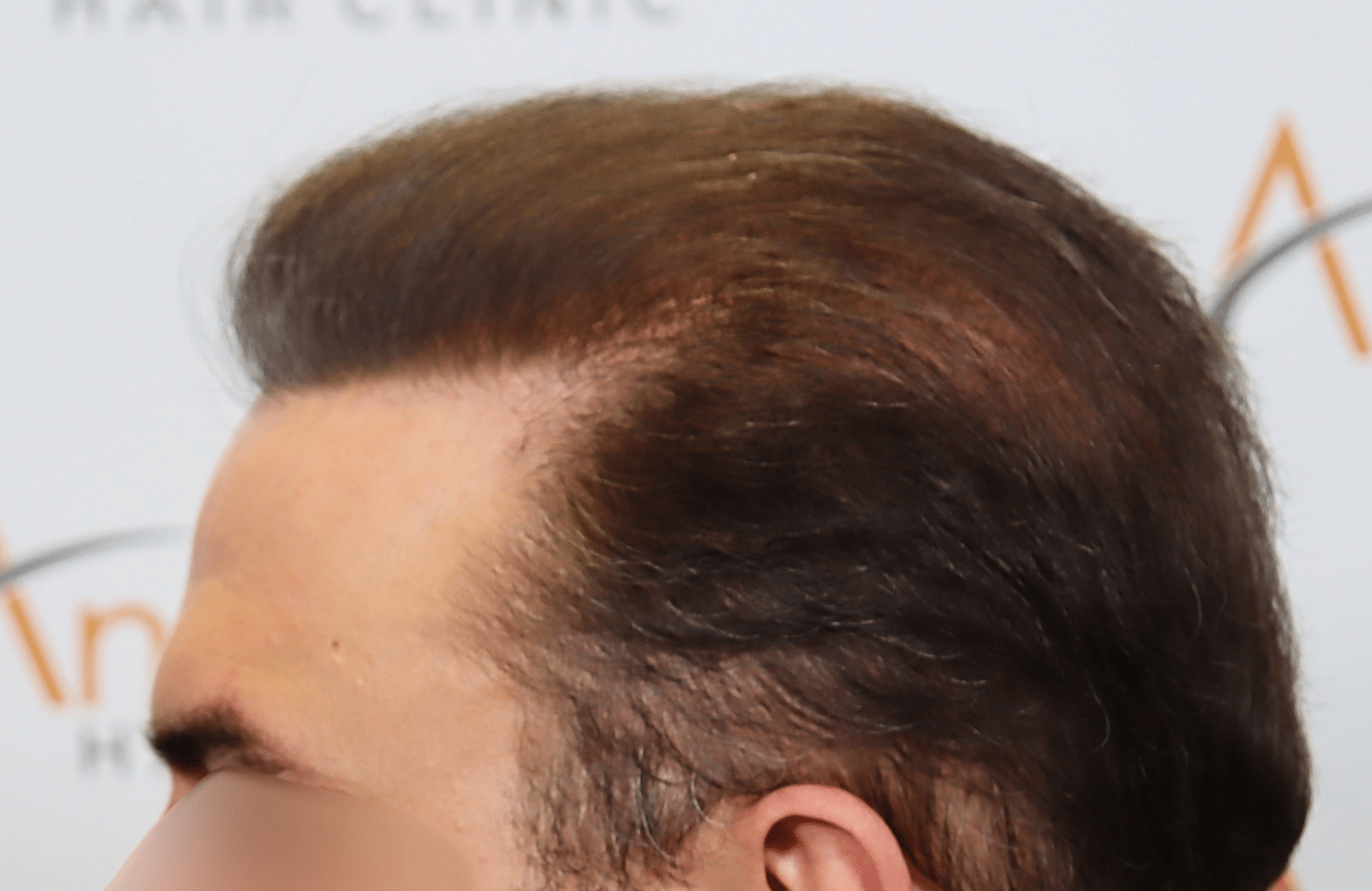 hair transplant result 5200 fus light (6)