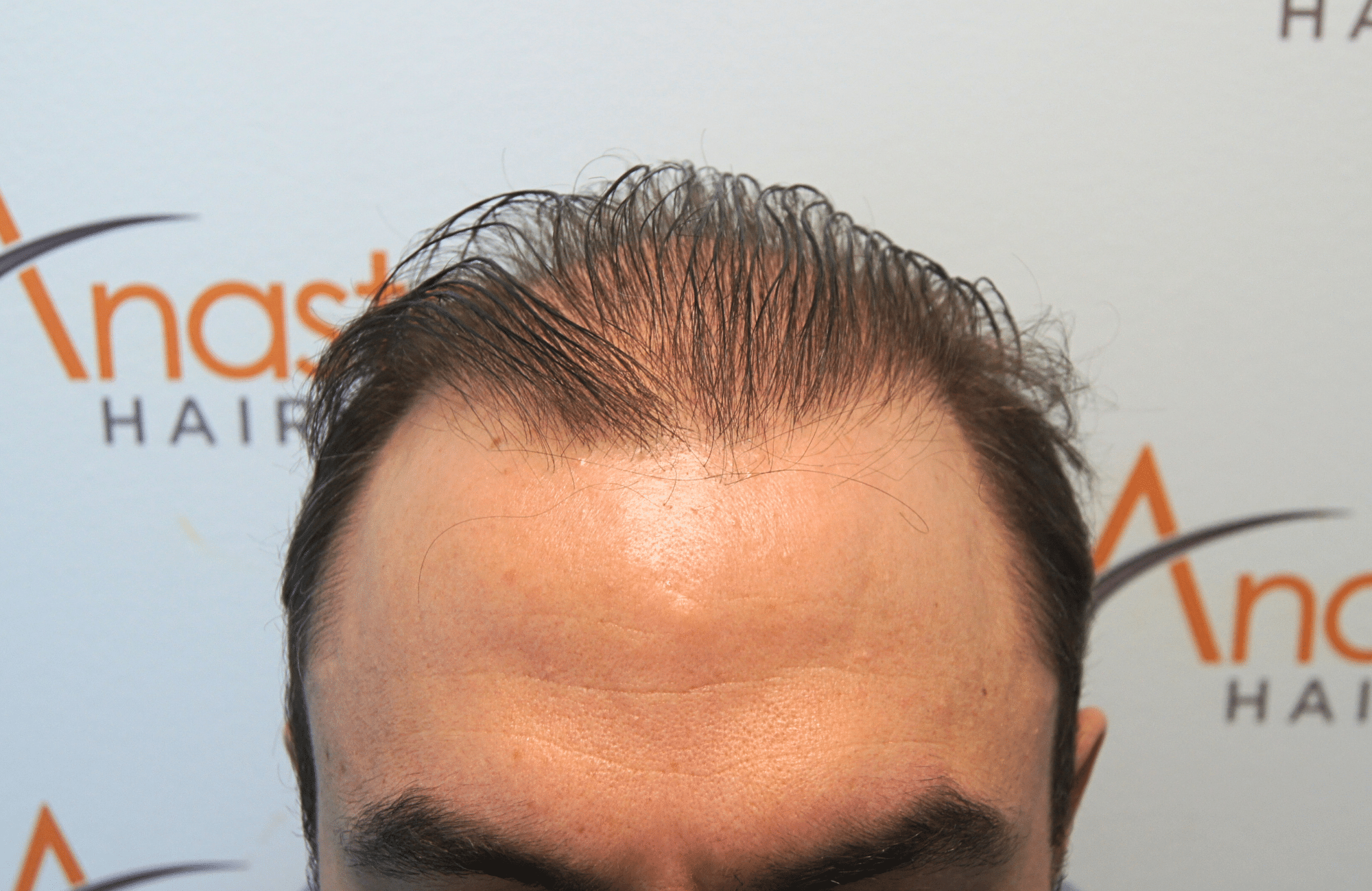 hair transplant result 5200 fus light (9)