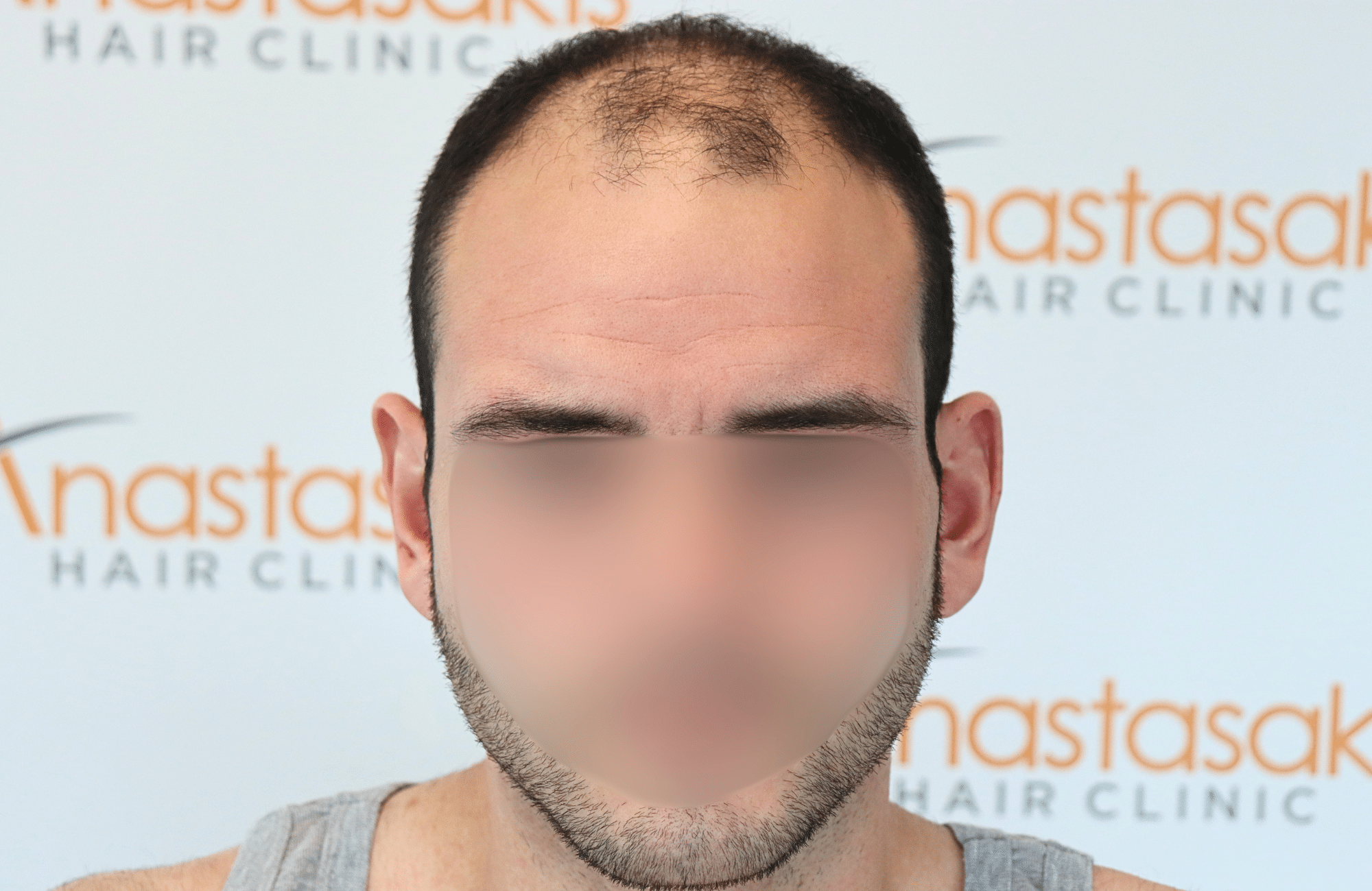 hair transplant result 2500 fus frontal (1)