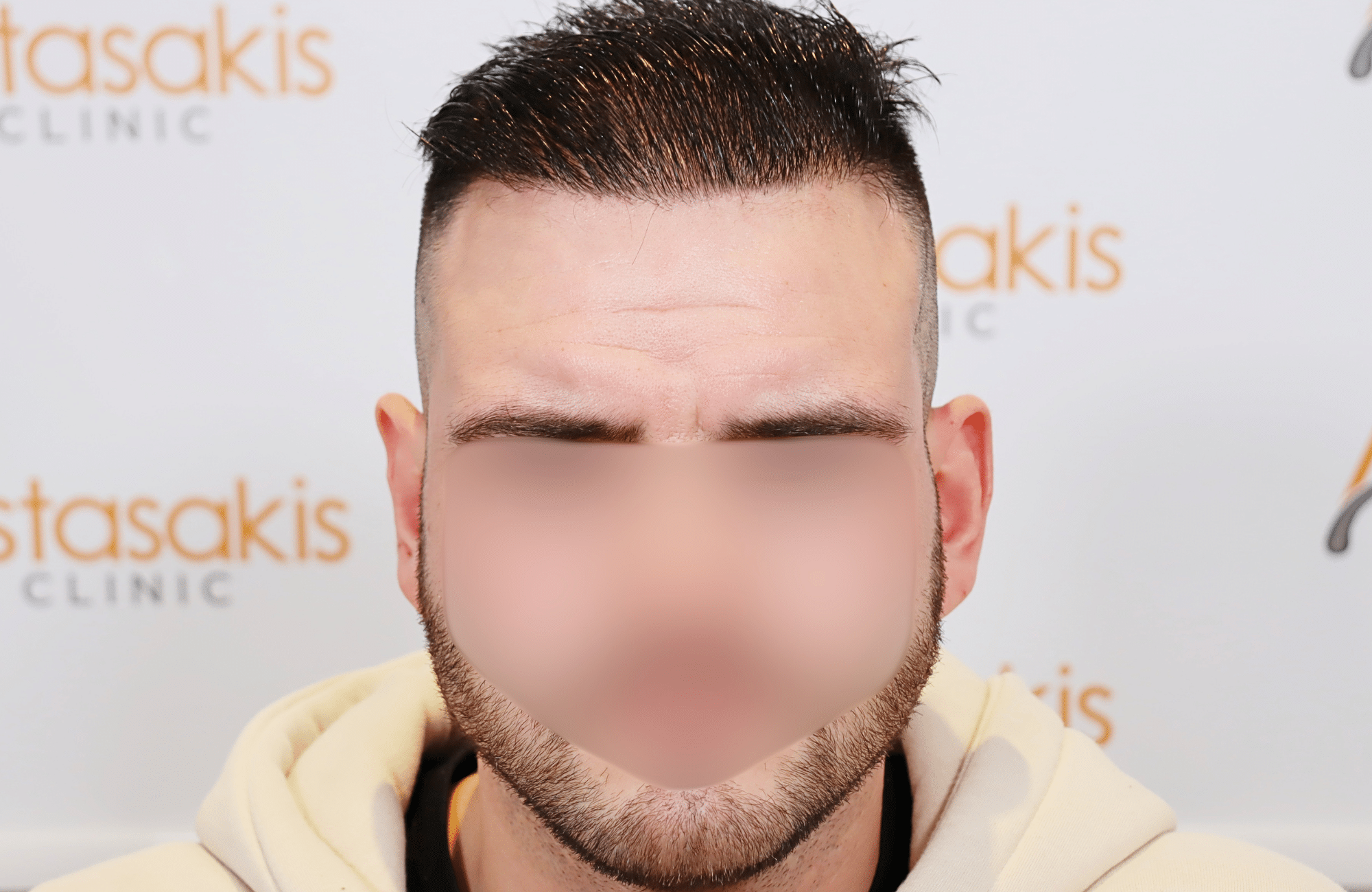hair transplant result 2500 fus frontal (13)
