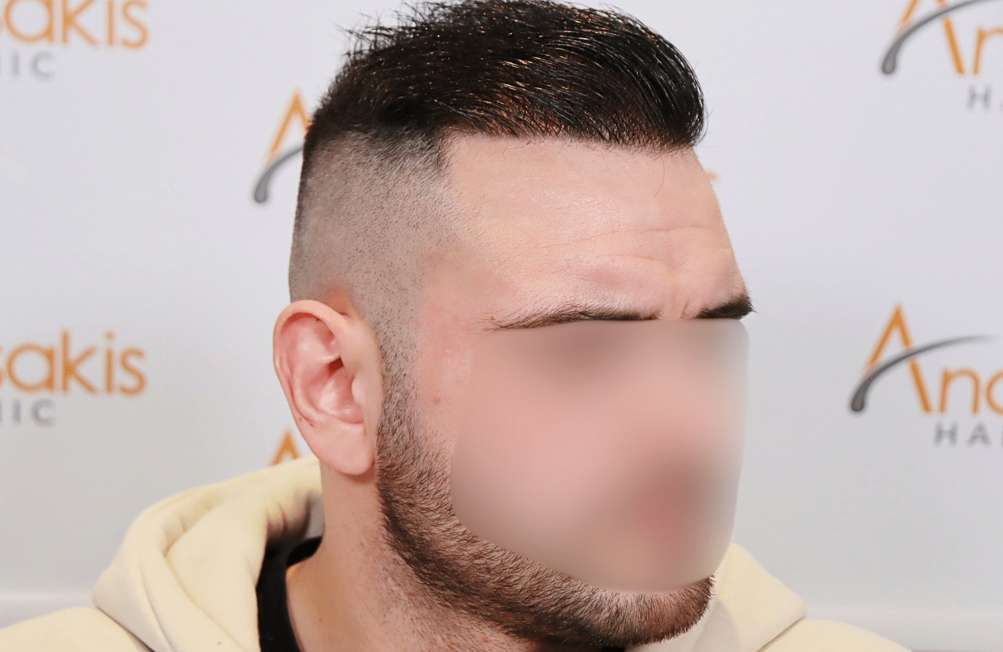 hair transplant result 2500 fus frontal (14)