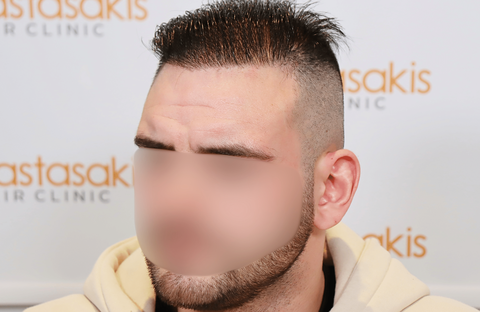hair transplant result 2500 fus frontal (15)