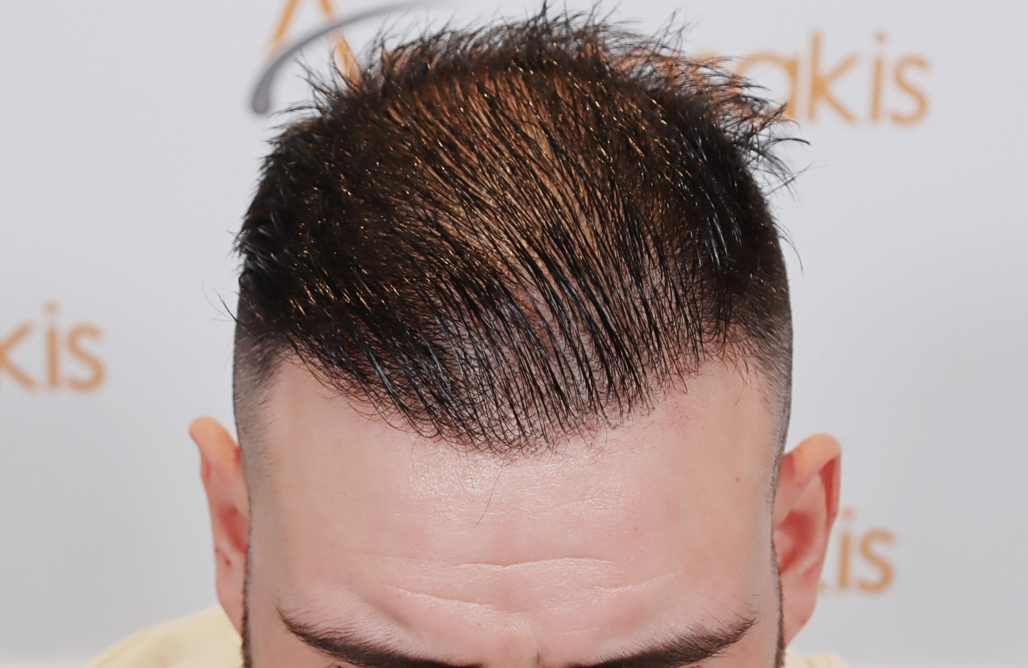 hair transplant result 2500 fus frontal (16)