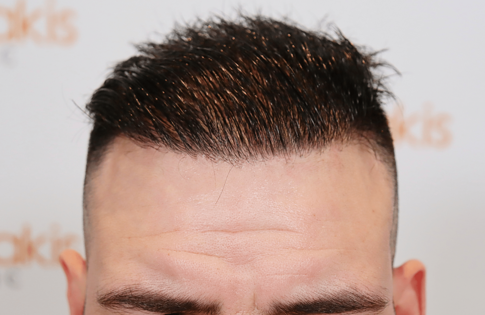 hair transplant result 2500 fus frontal (17)