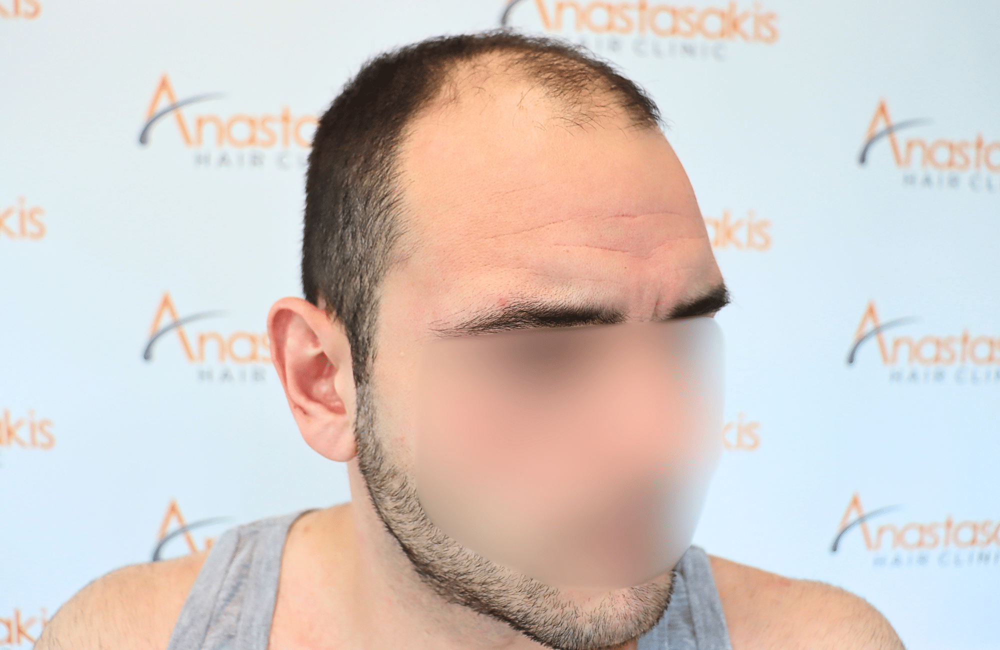 hair transplant result 2500 fus frontal (3)