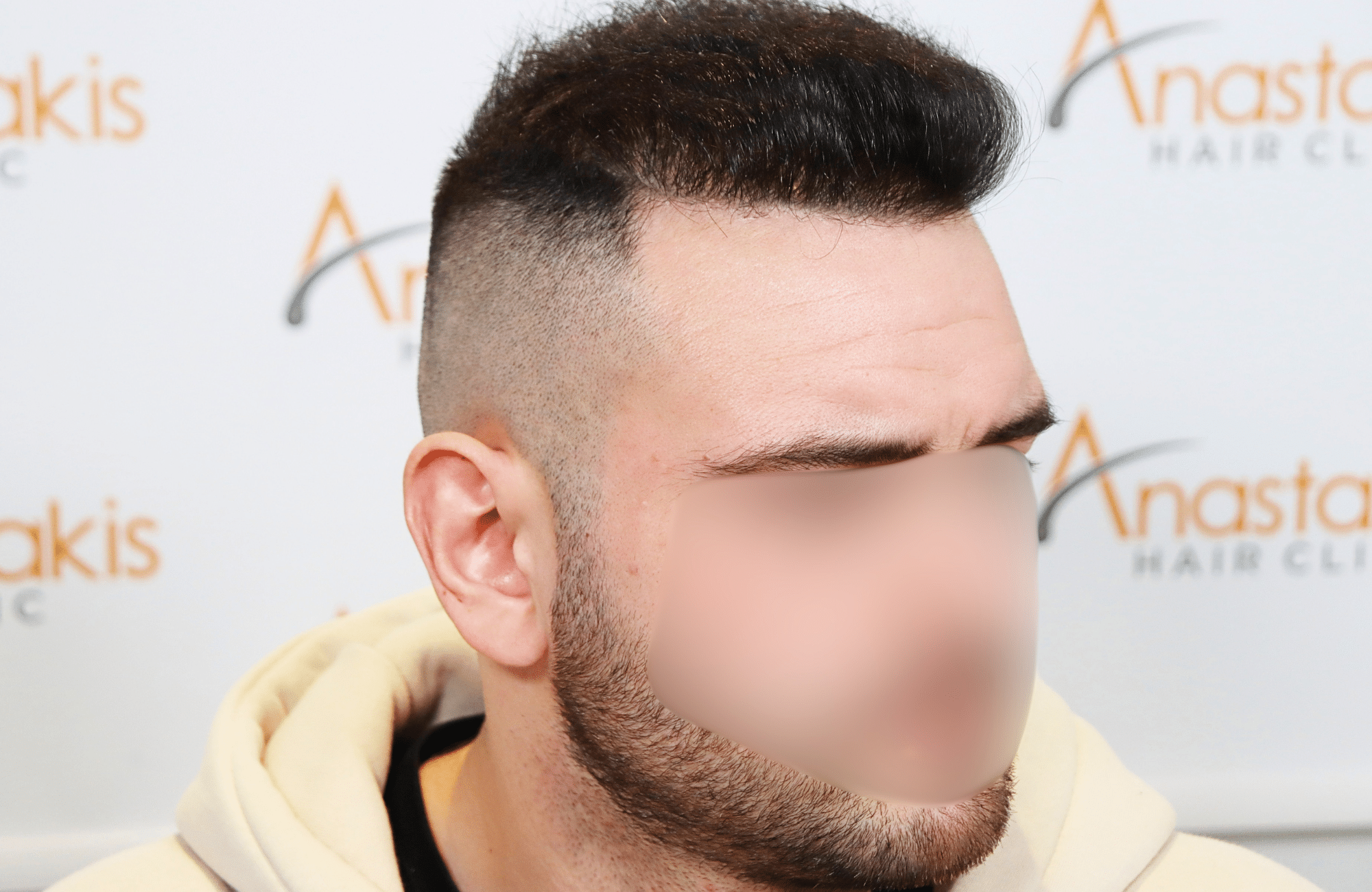 hair transplant result 2500 fus frontal (4)