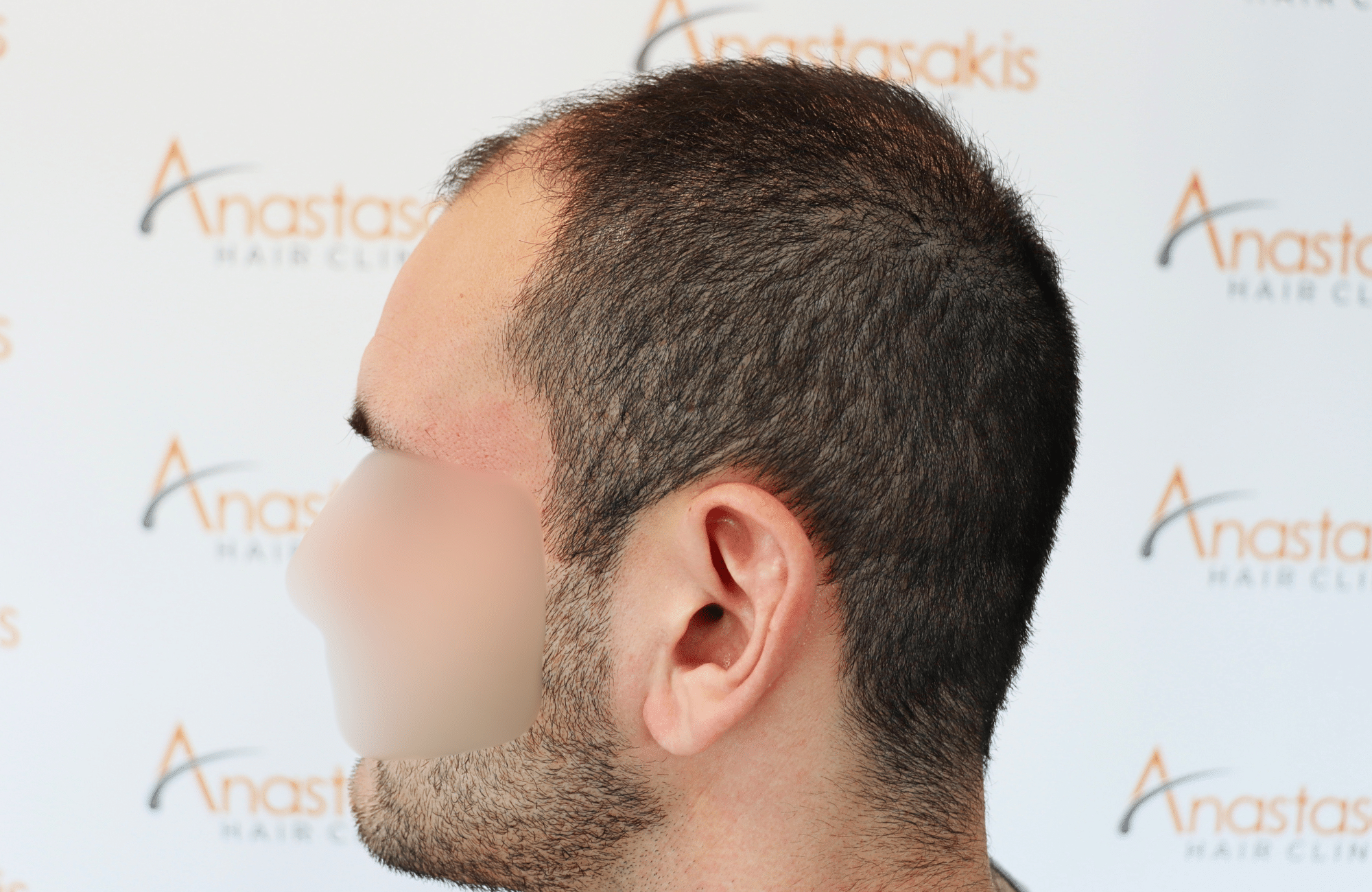 hair transplant result 2500 fus frontal (9)