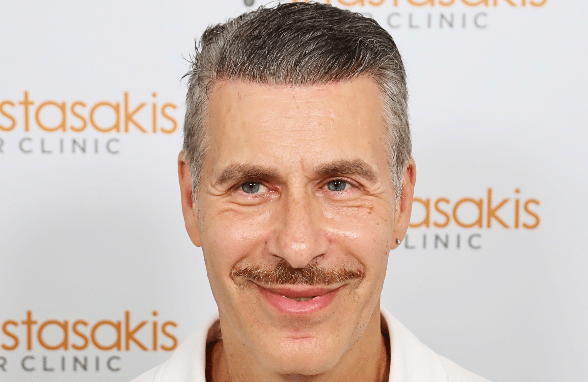 hair transplant result 2500 fus grey (1)