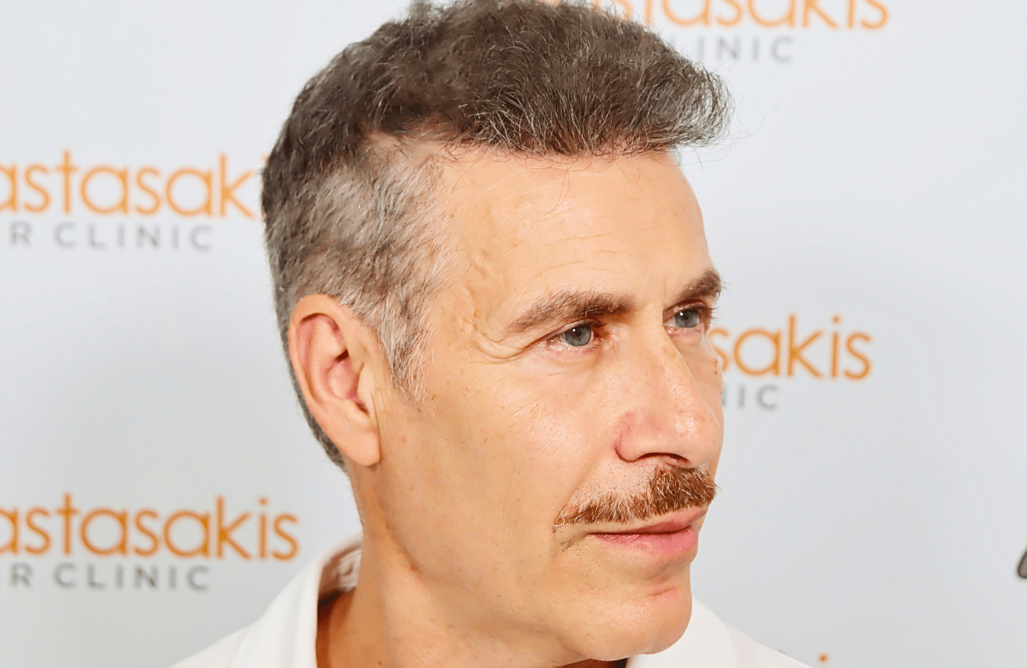 hair transplant result 2500 fus grey (10)