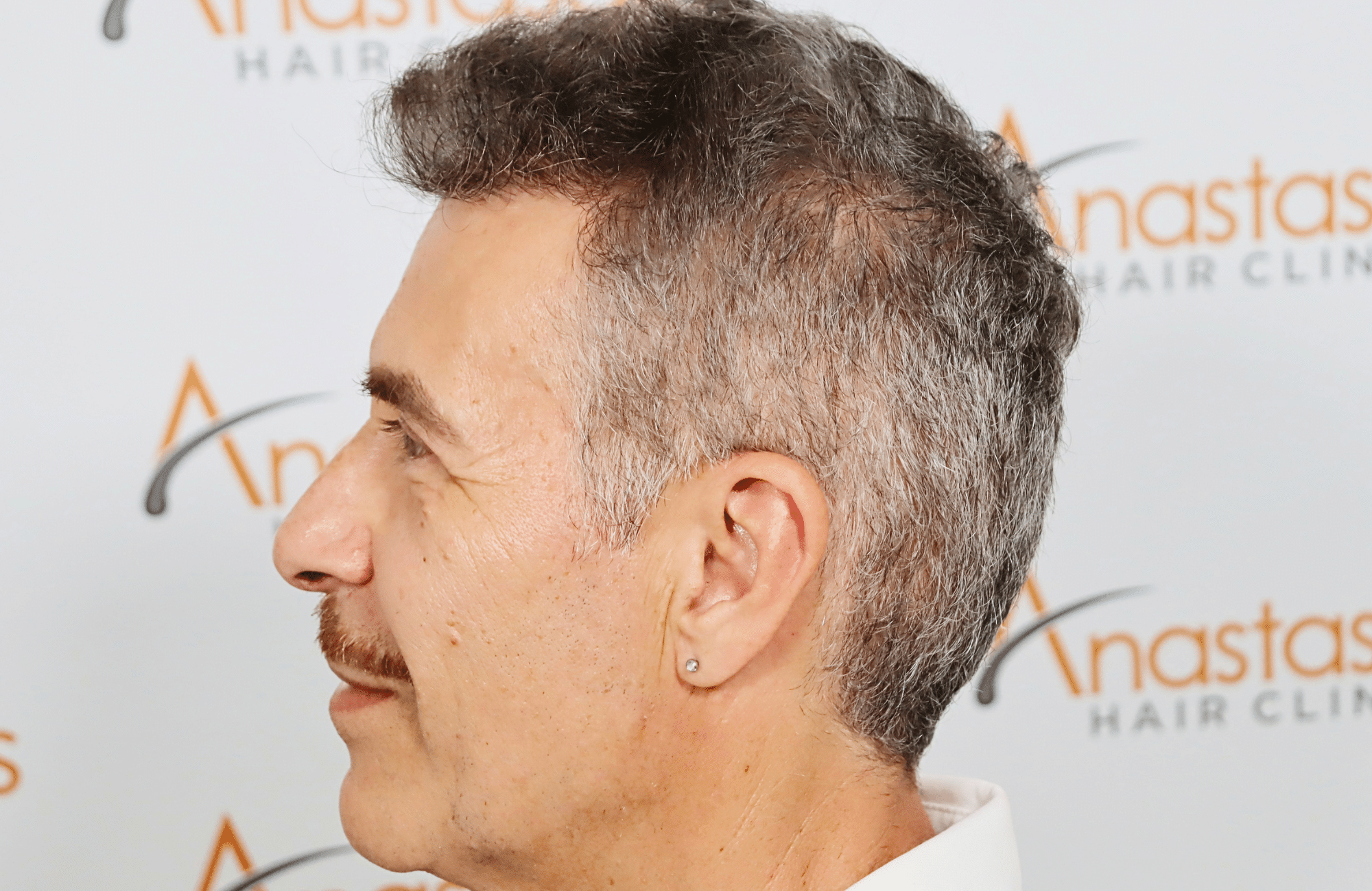hair transplant result 2500 fus grey (16)