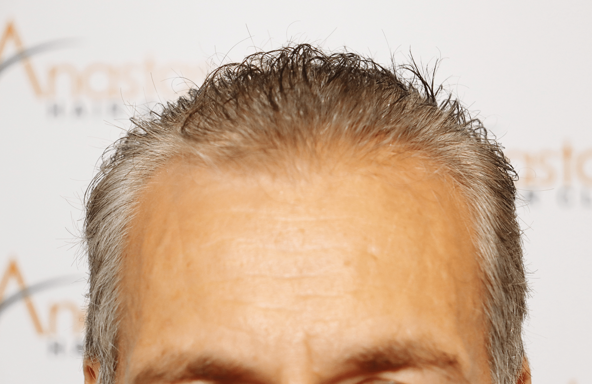 hair transplant result 2500 fus grey (19)