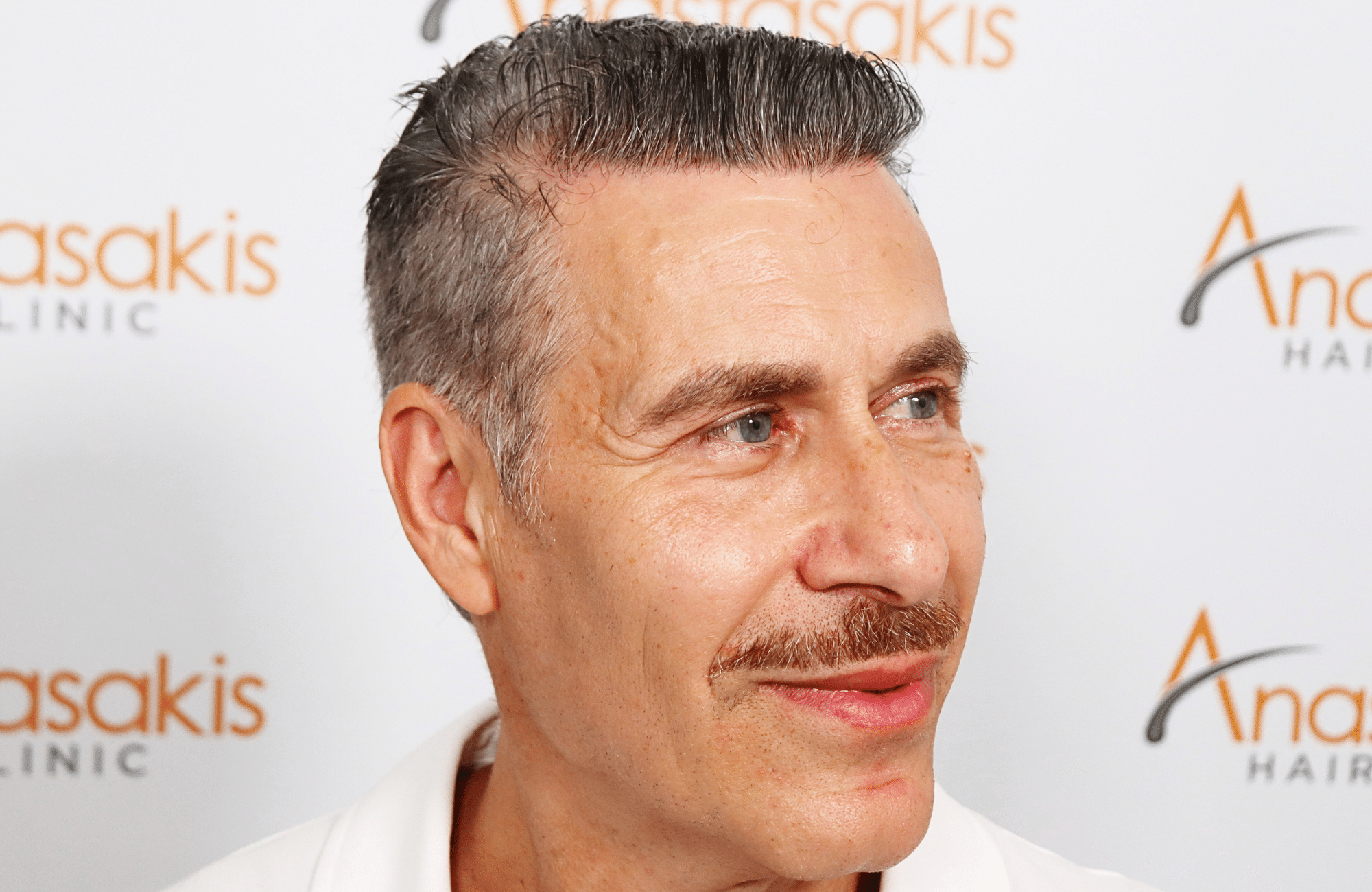 hair transplant result 2500 fus grey (2)
