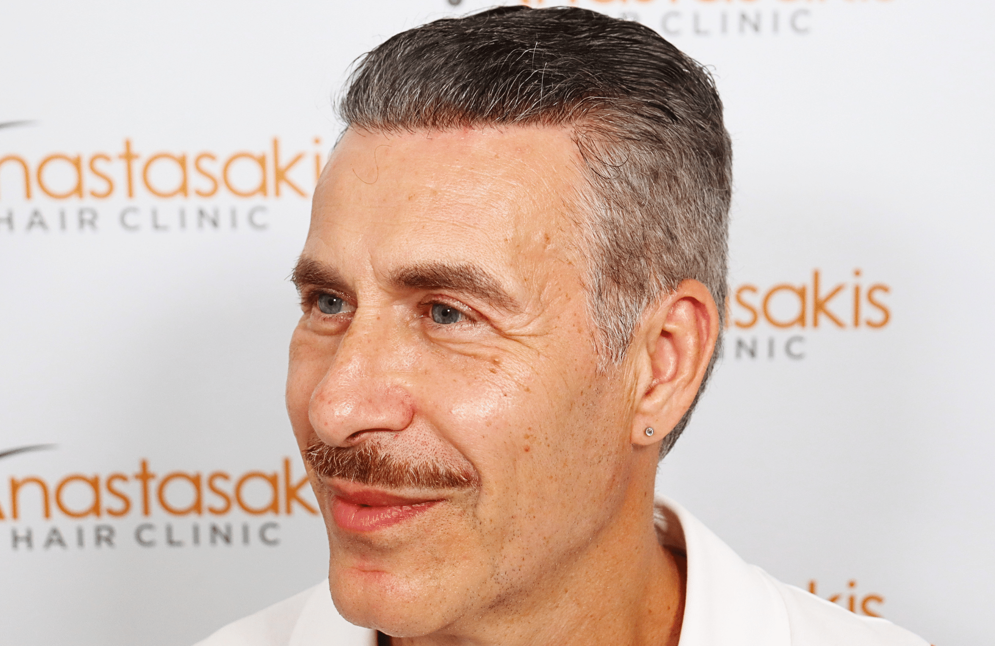 hair transplant result 2500 fus grey (3)
