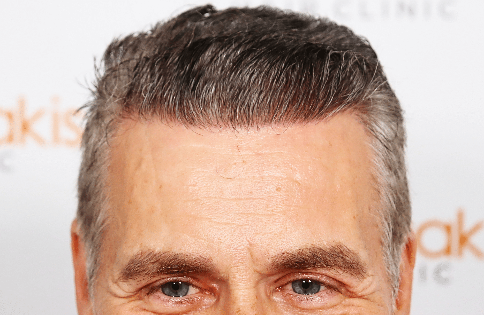hair transplant result 2500 fus grey (4)