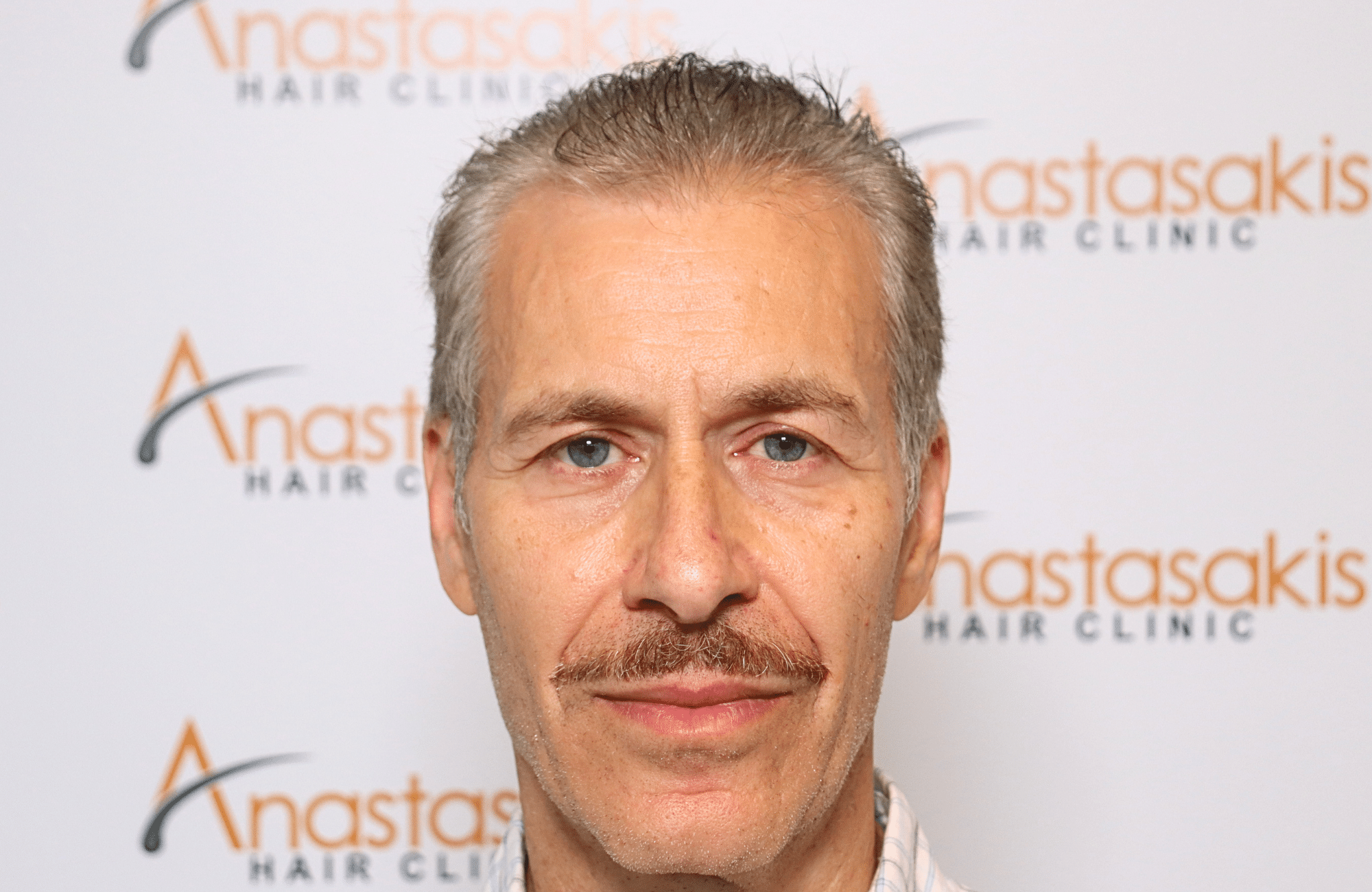 hair transplant result 2500 fus grey (7)