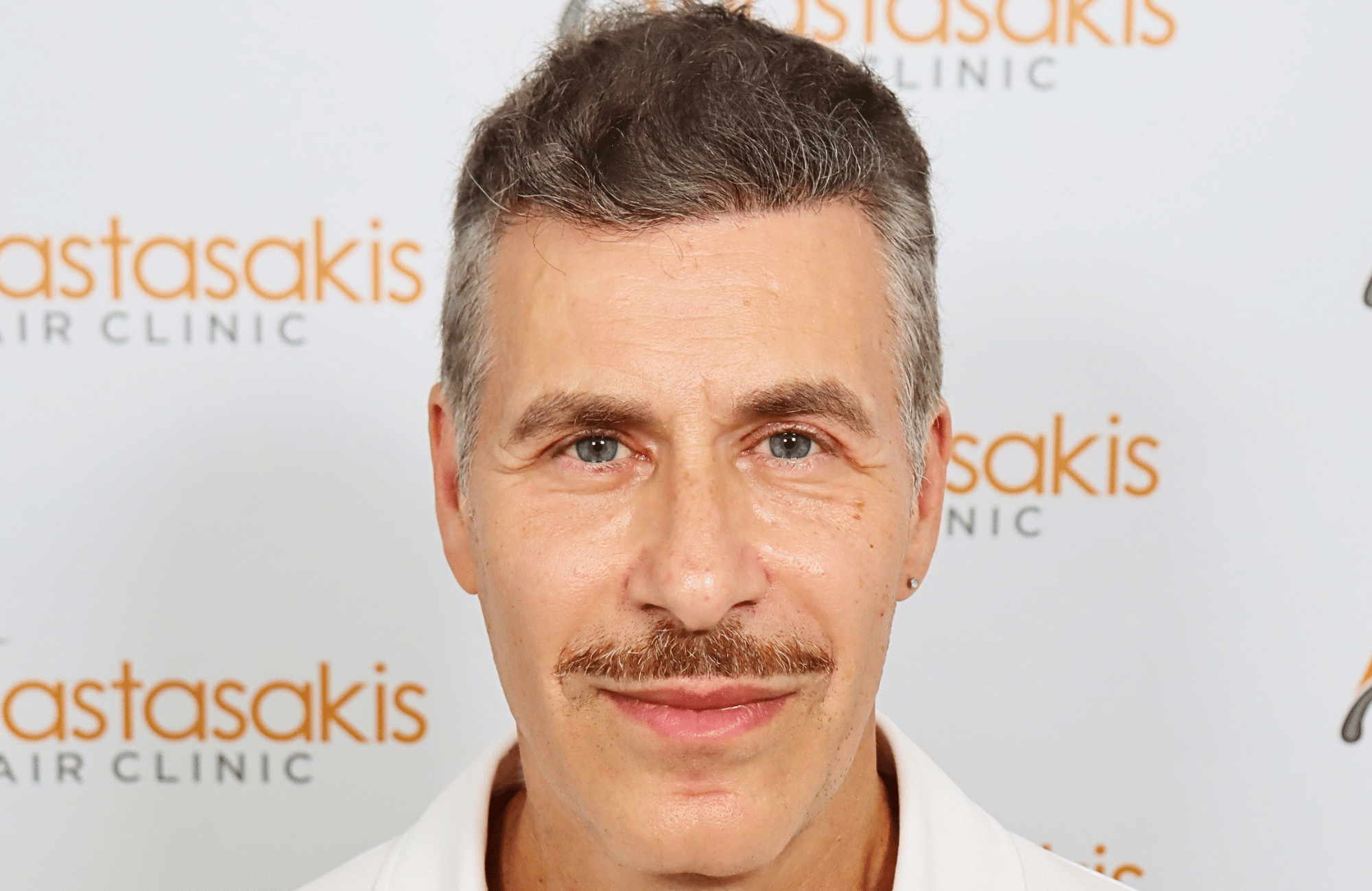 hair transplant result 2500 fus grey (8)