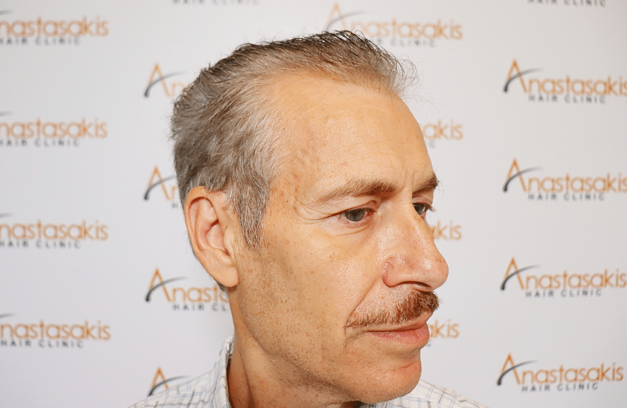 hair transplant result 2500 fus grey (9)