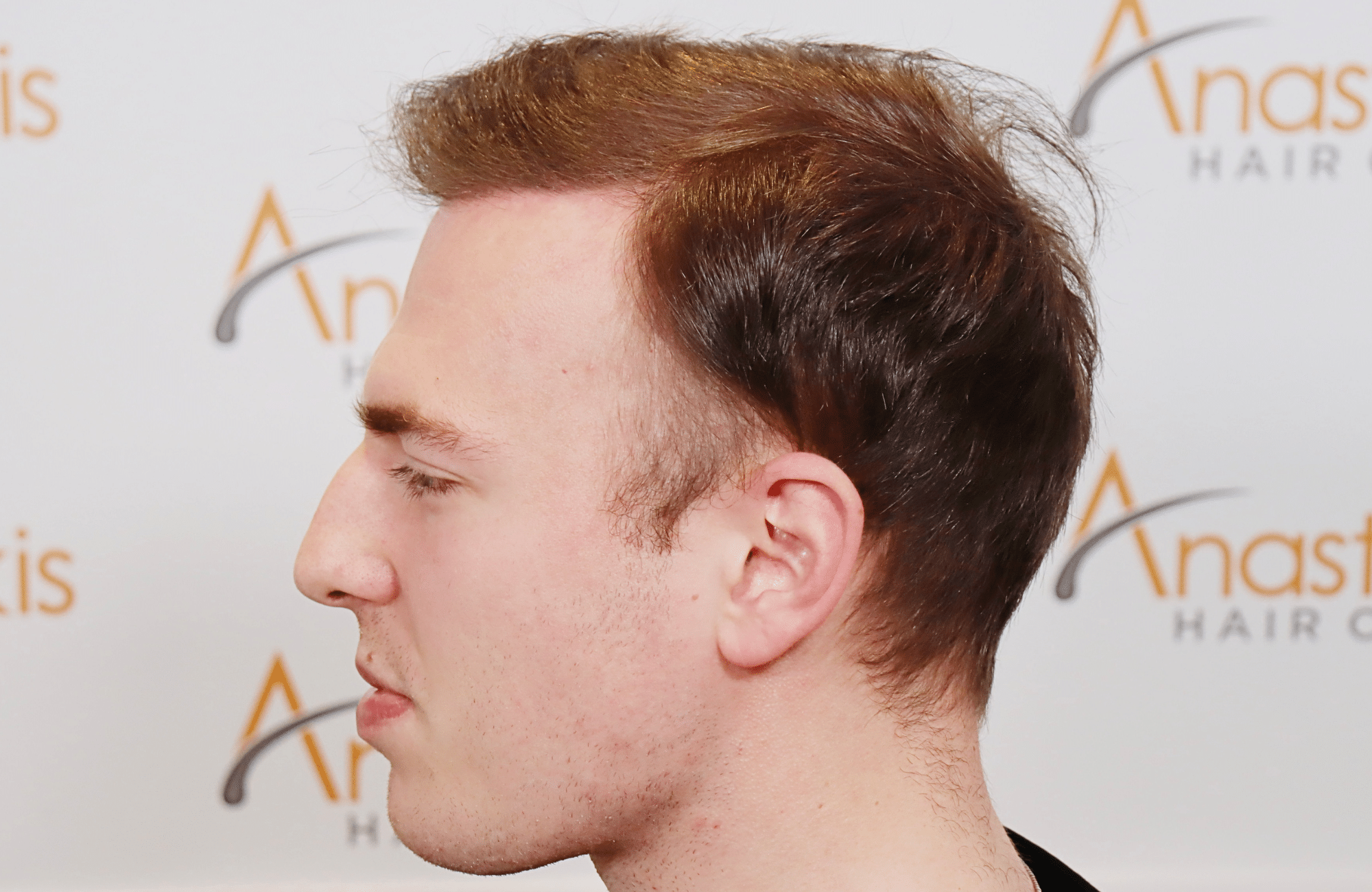 hair transplant result 2500 fus light (1)