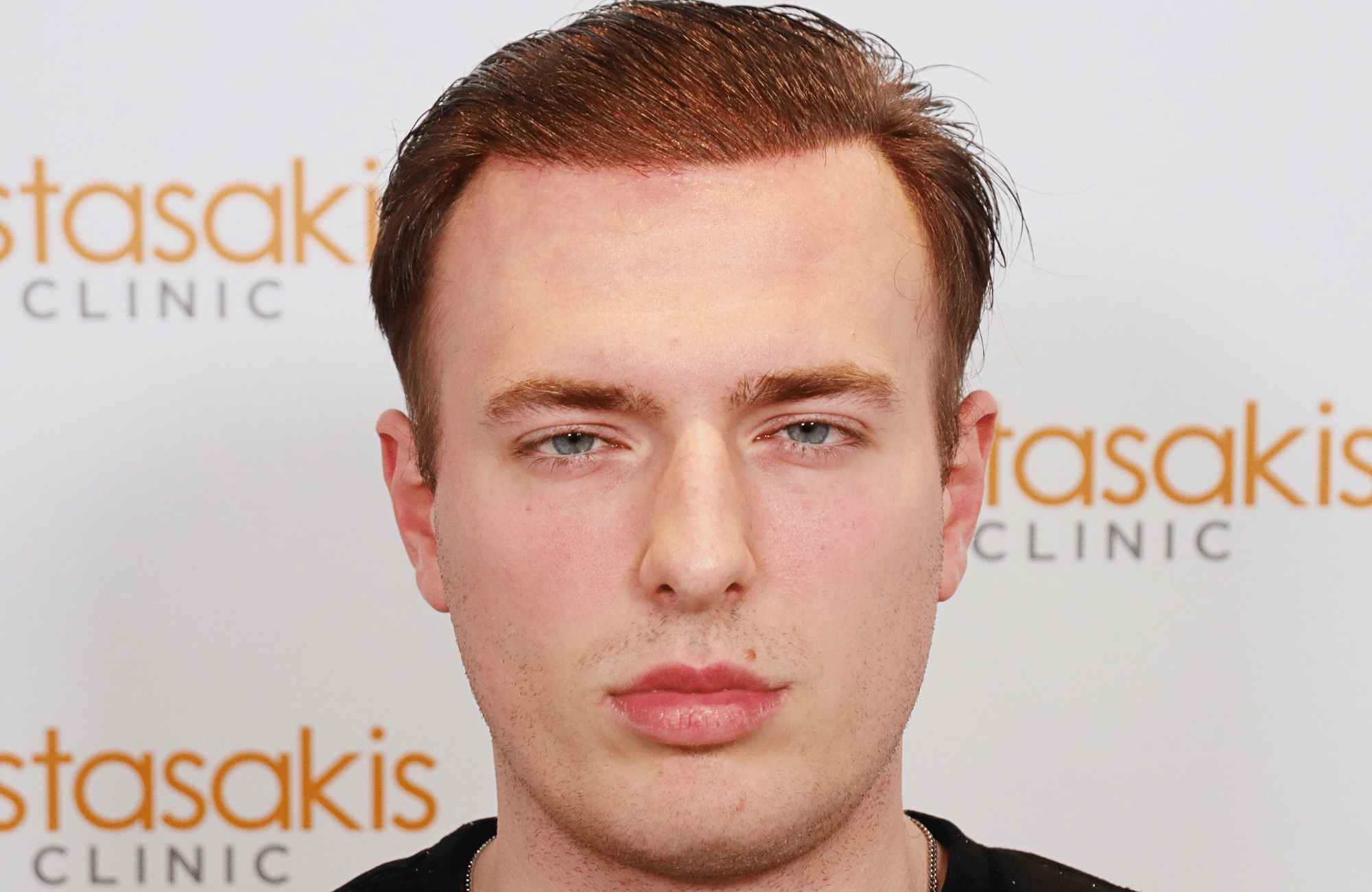 hair transplant result 2500 fus light (10)