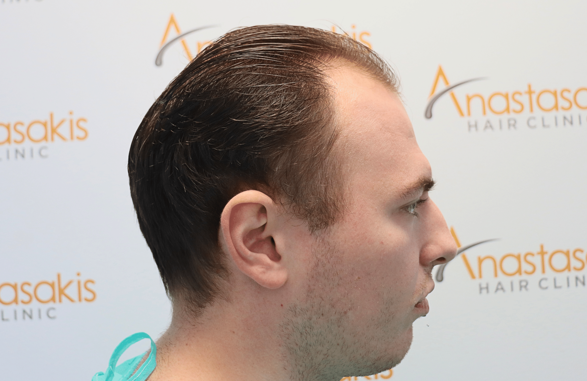 hair transplant result 2500 fus light (16)