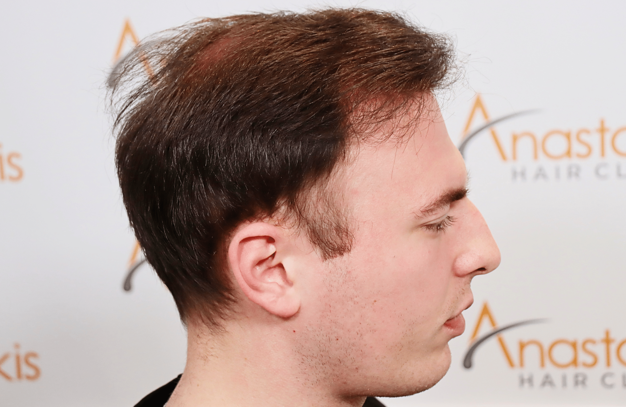 hair transplant result 2500 fus light (17)