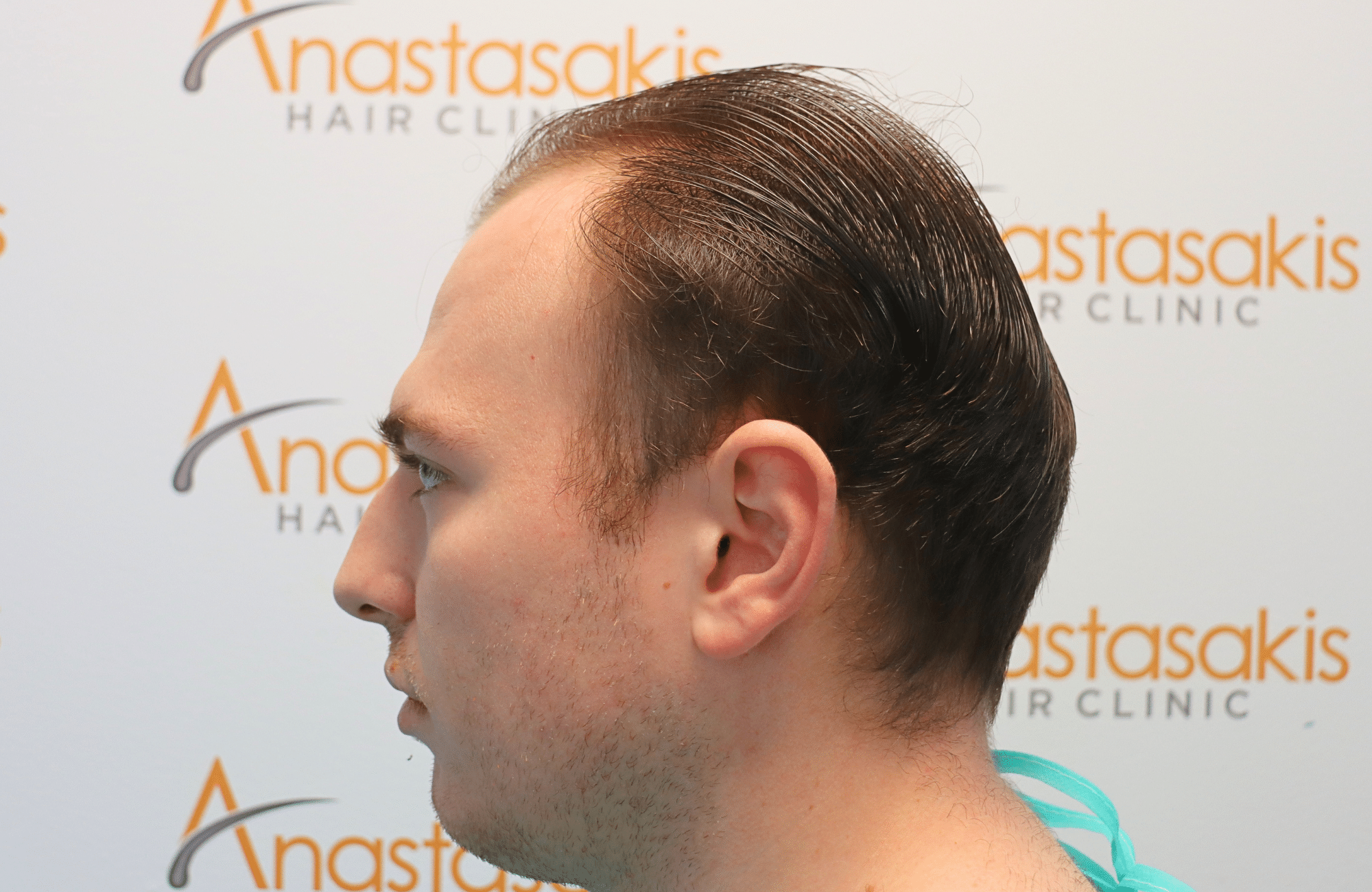 hair transplant result 2500 fus light (18)