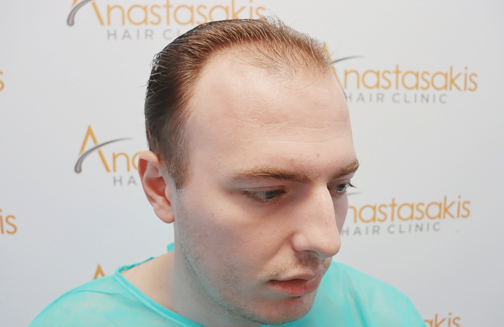 hair transplant result 2500 fus light (2)