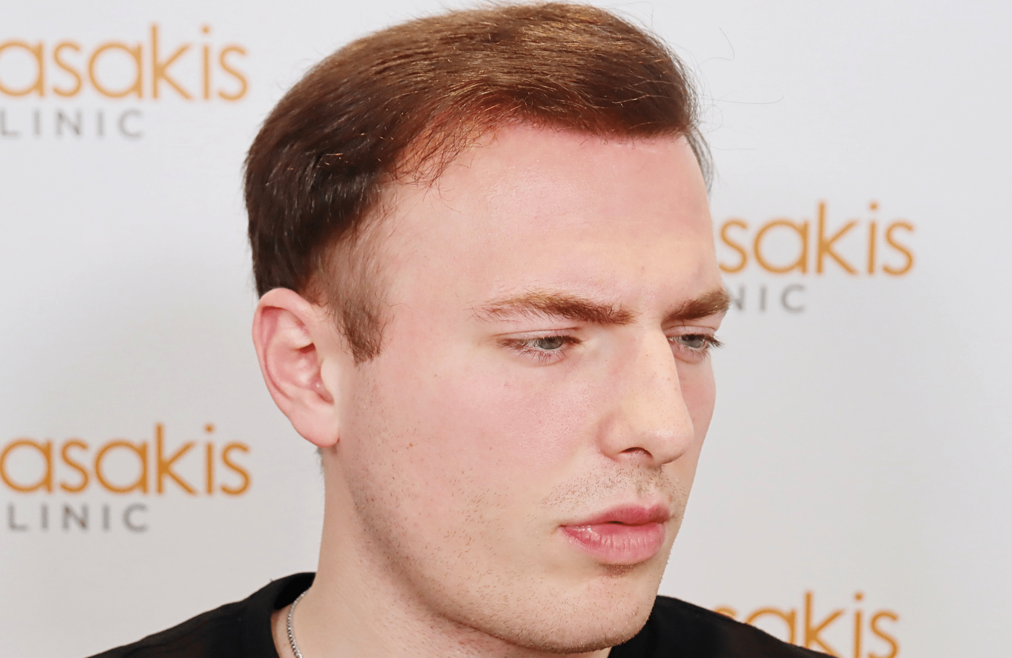 hair transplant result 2500 fus light (3)