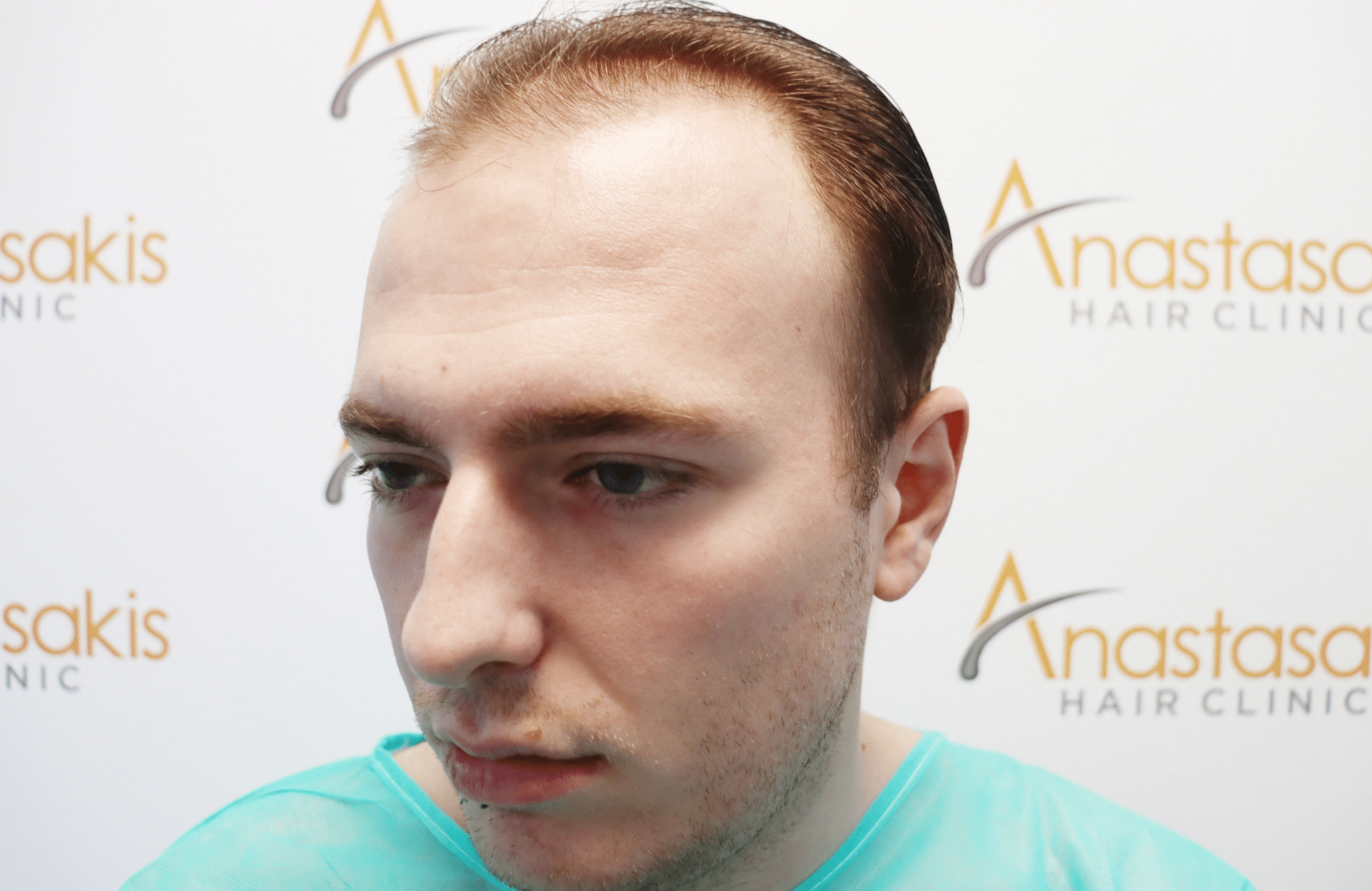 hair transplant result 2500 fus light (4)