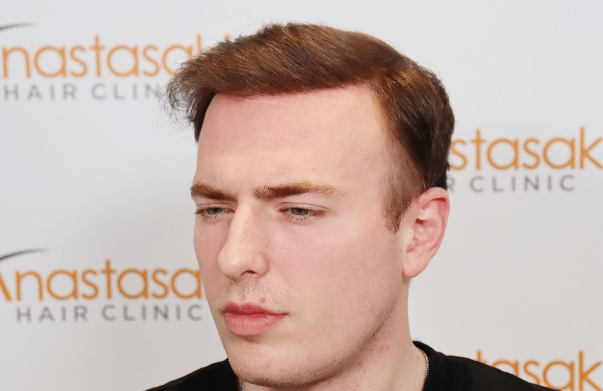 hair transplant result 2500 fus light (5)