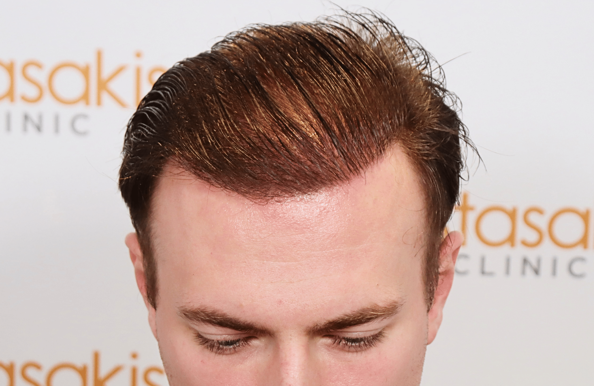 hair transplant result 2500 fus light (7)