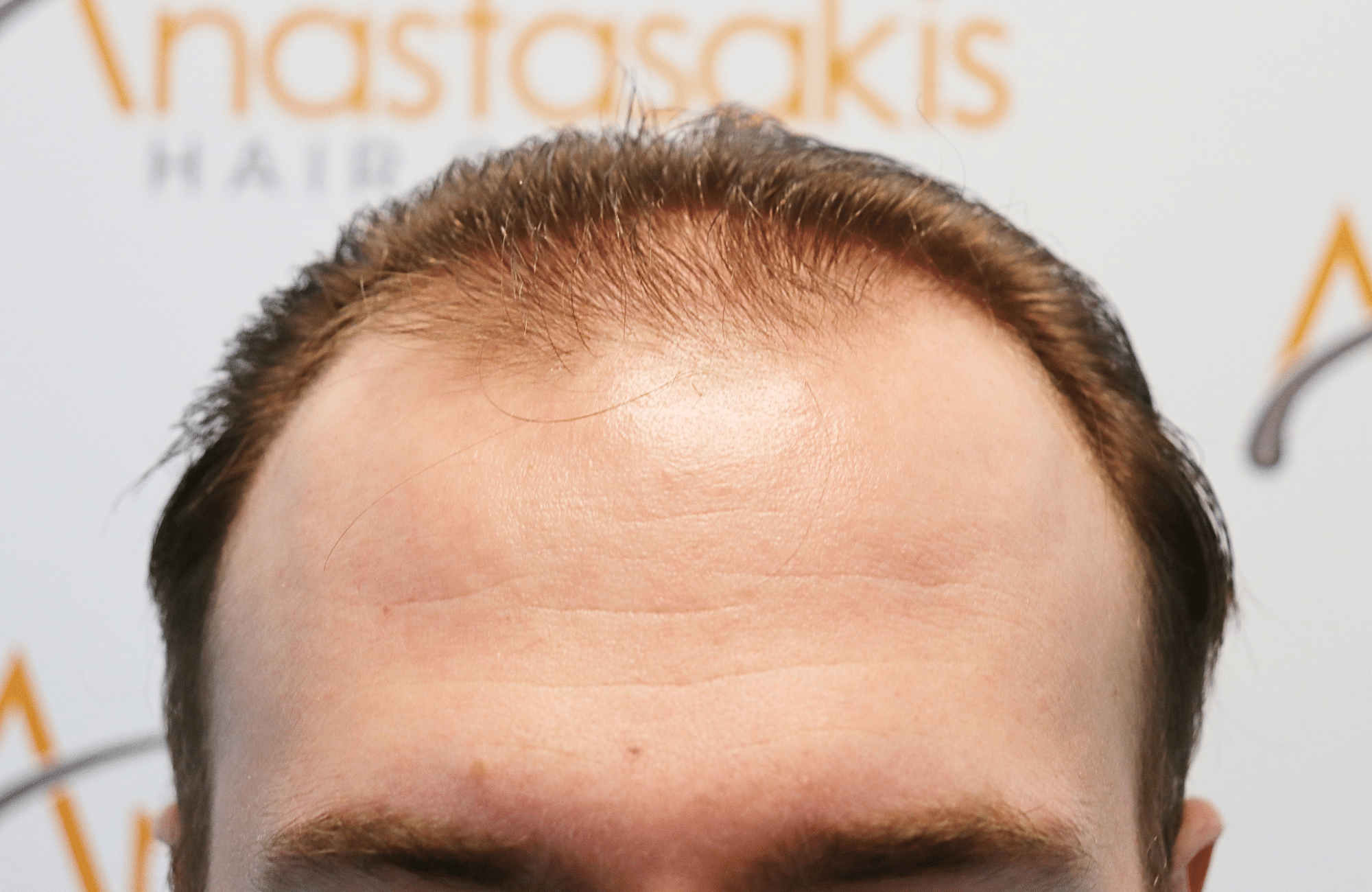 hair transplant result 2500 fus light (8)