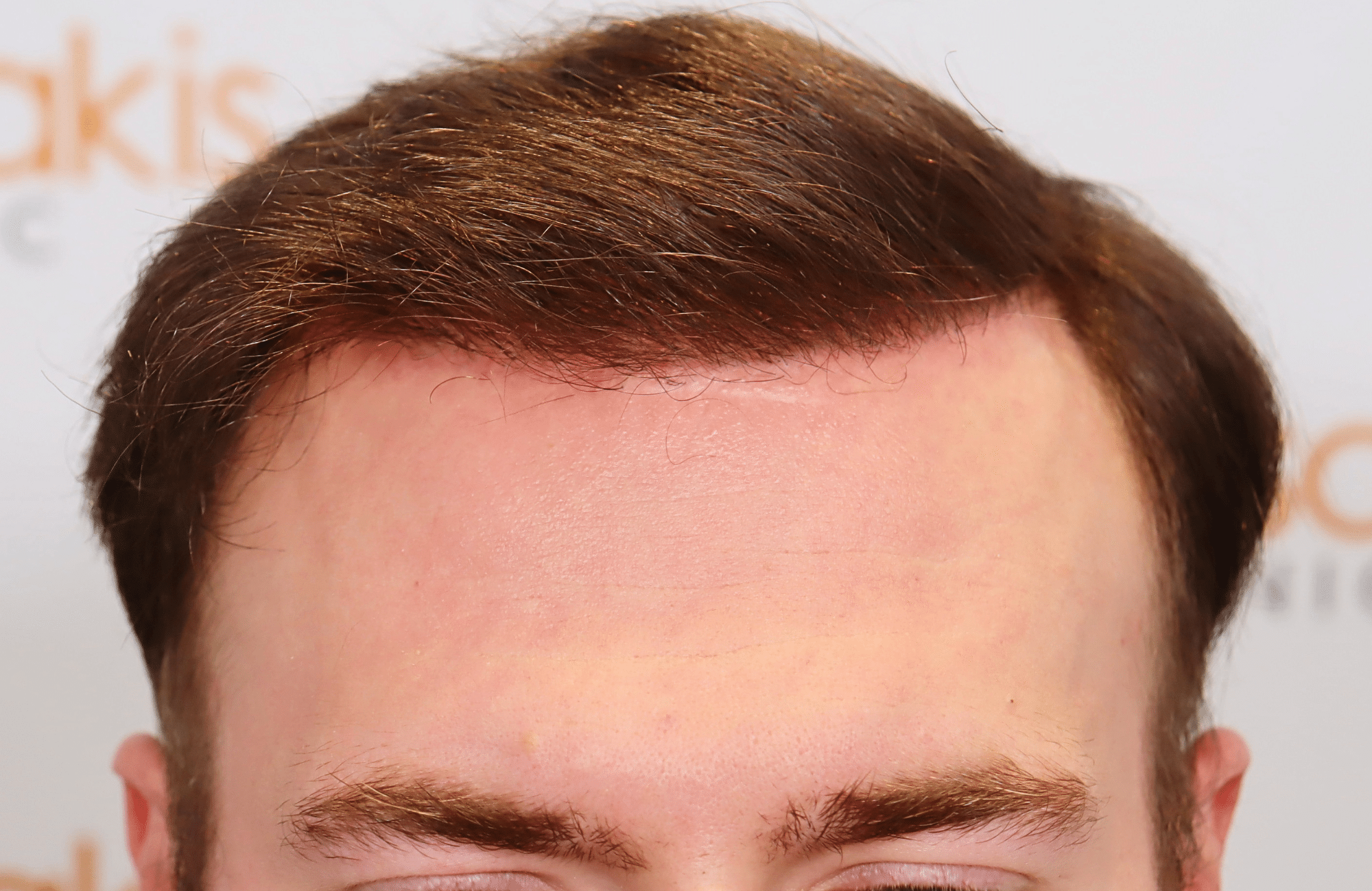 hair transplant result 2500 fus light (9)